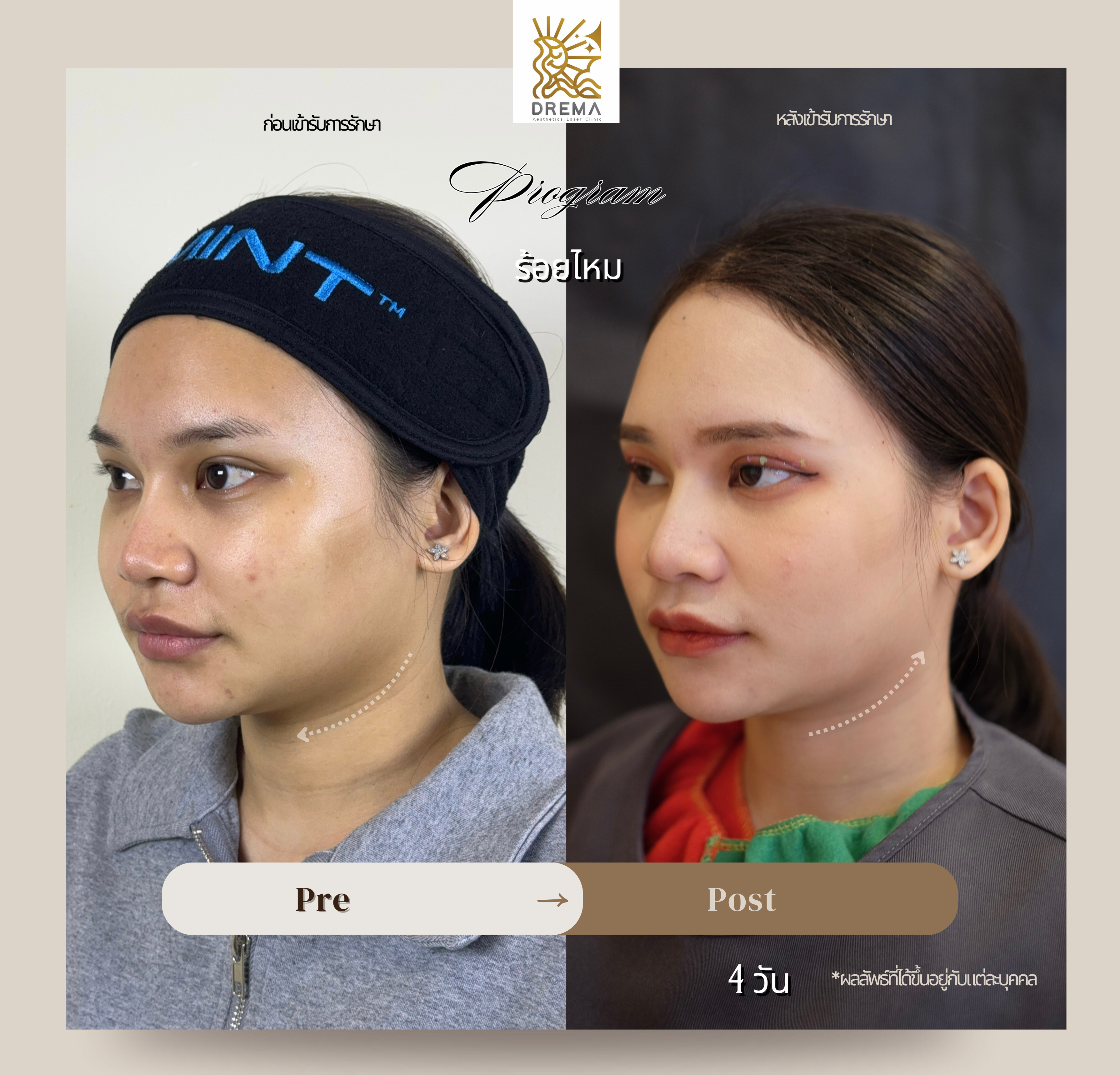 รูปรีวิว ร้อยไหม Drema Clinic เคสที่ 22
