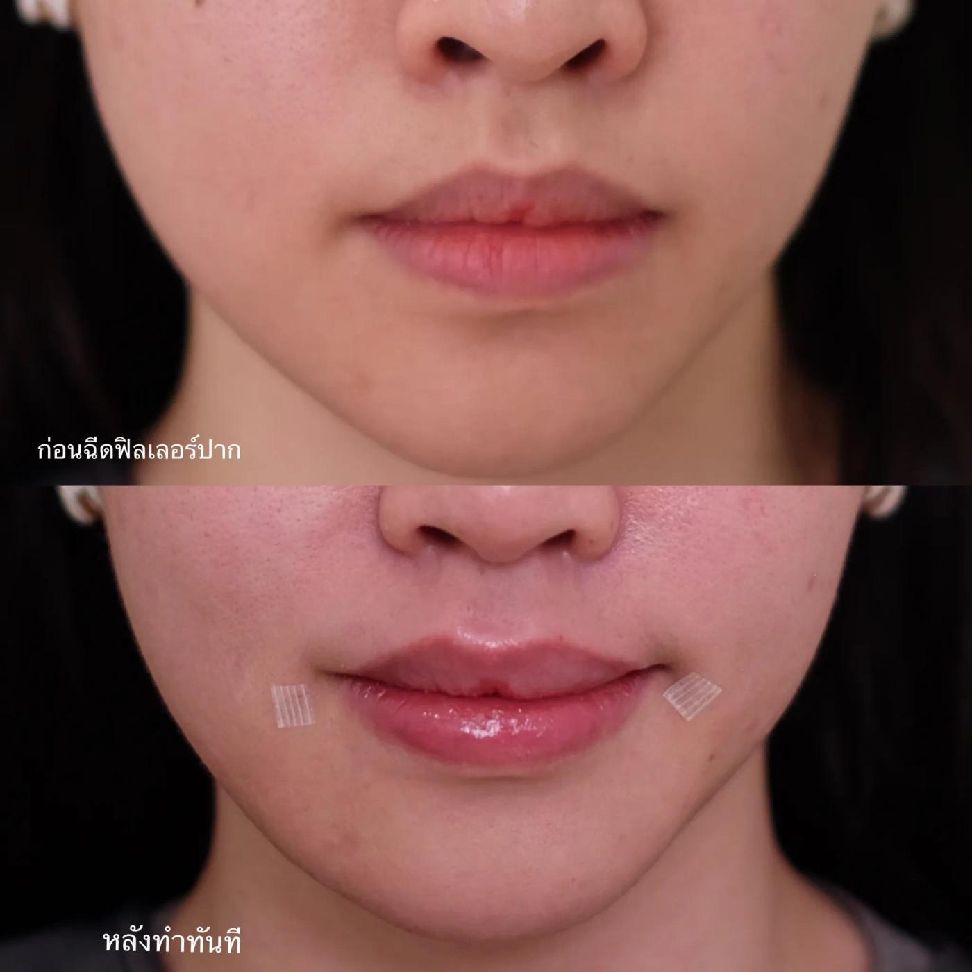 รีวิว Filler ปาก 34