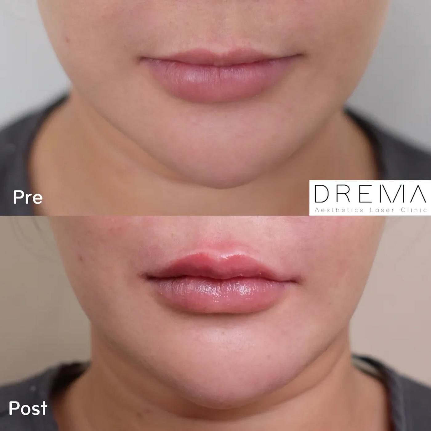 รีวิว Filler ปาก 2