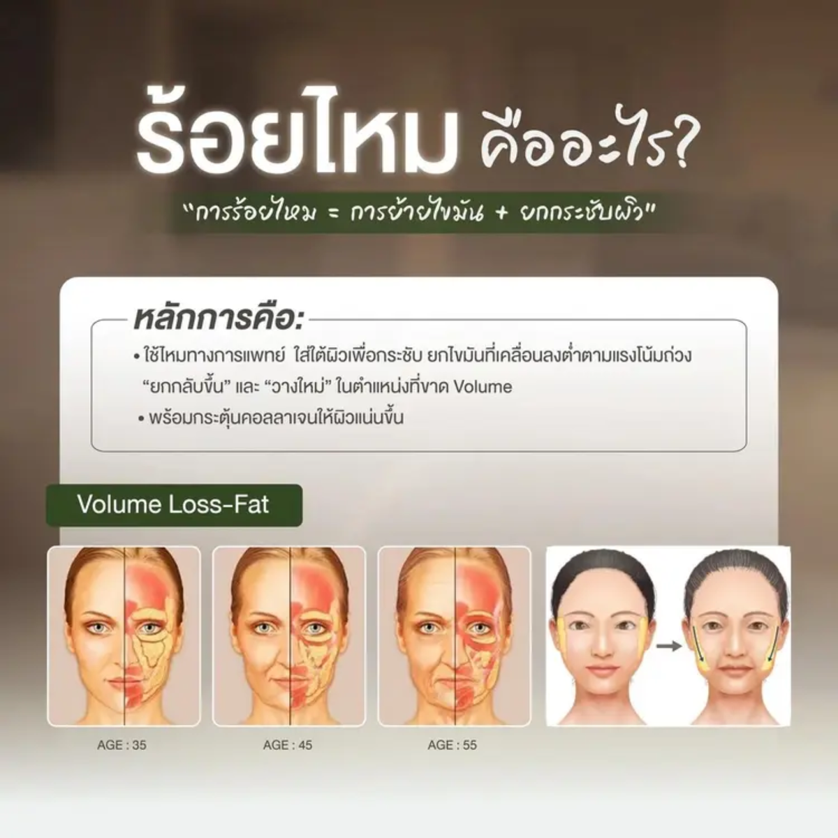 ยกกระชับใบหน้าให้เรียวสวย ด้วยการร้อยไหม (Thread Lifting) - Drema Clinic