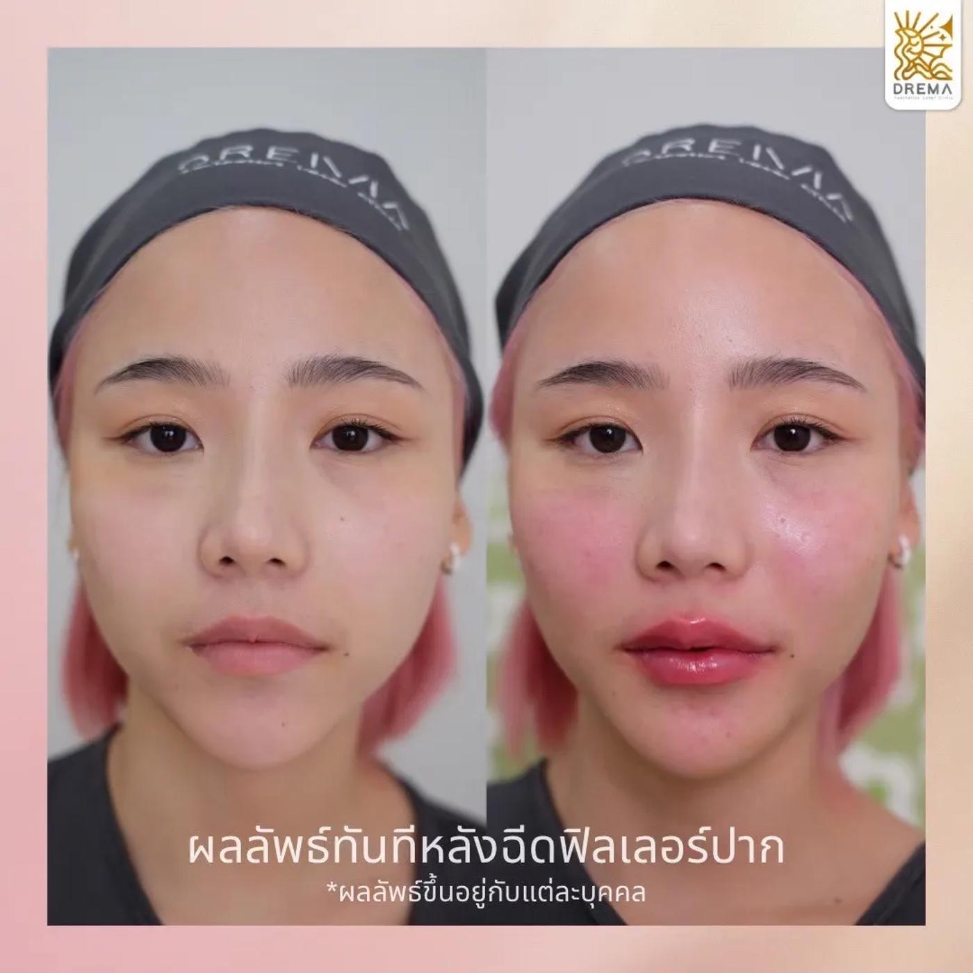 รีวิว Filler ปาก 6