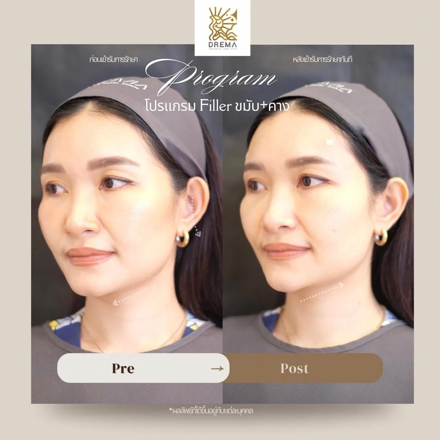 รีวิว ฟิลเลอร์คาง 4