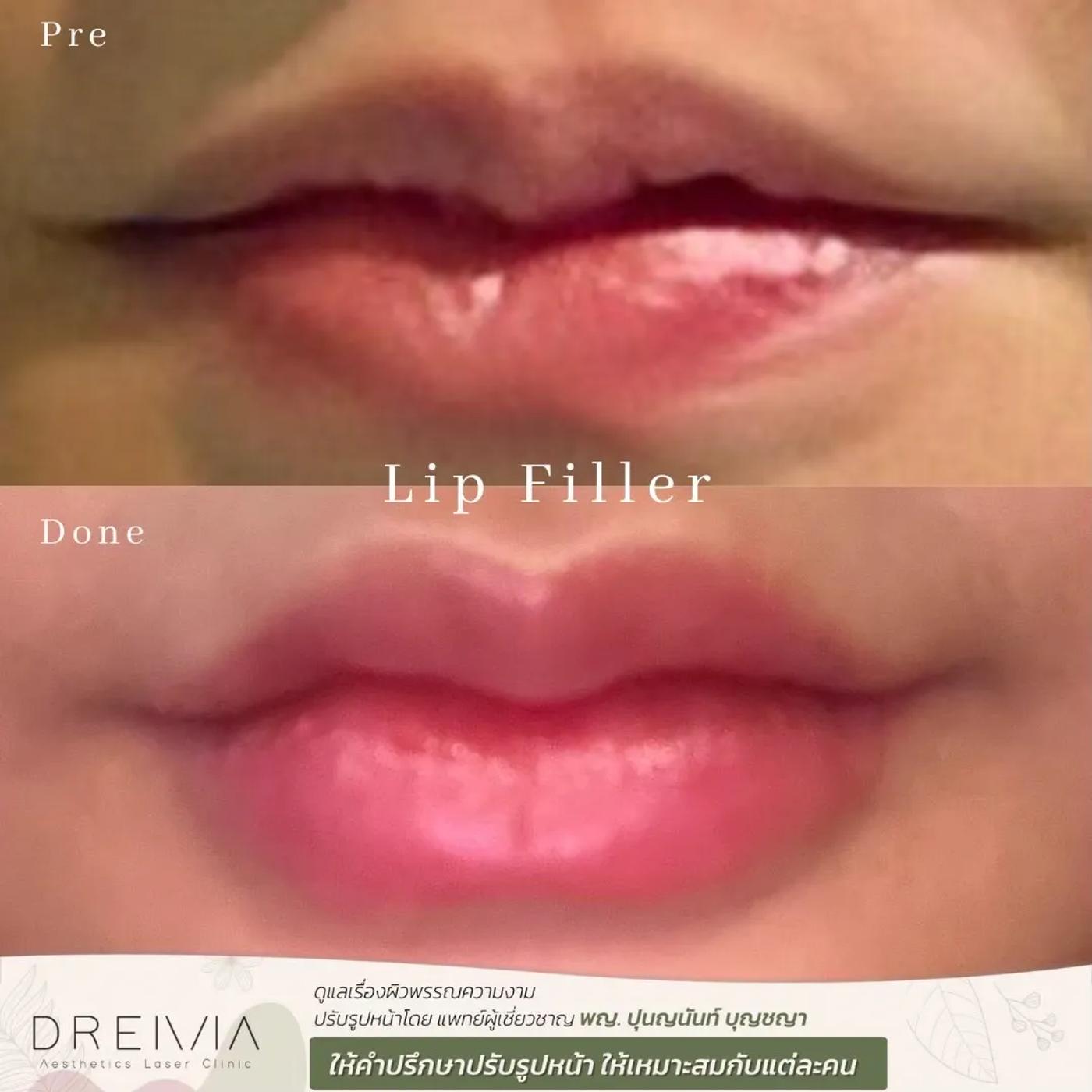 รีวิว Filler ปาก 25