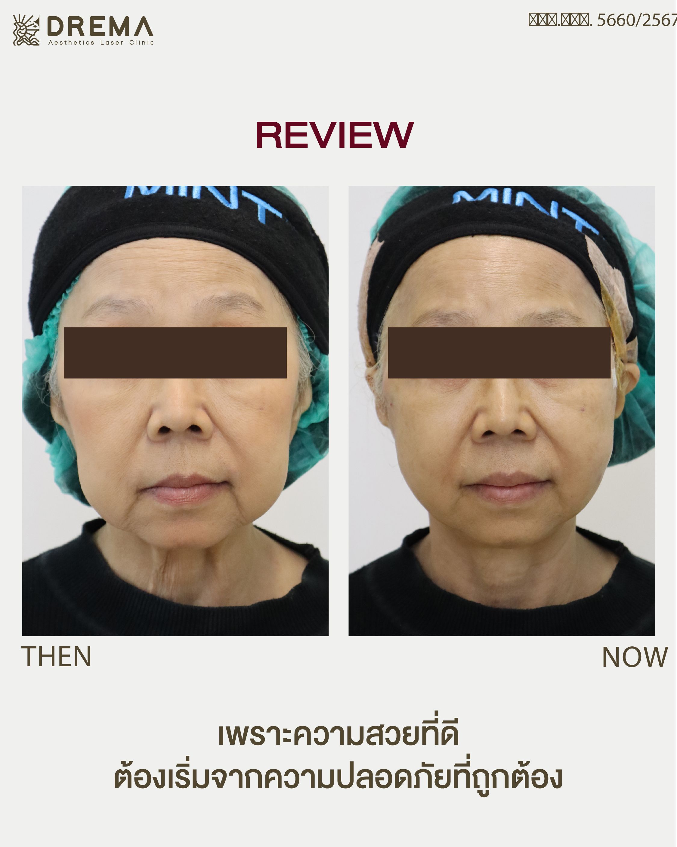 ร้อยไหมยกหน้าหย่อนคล้อย