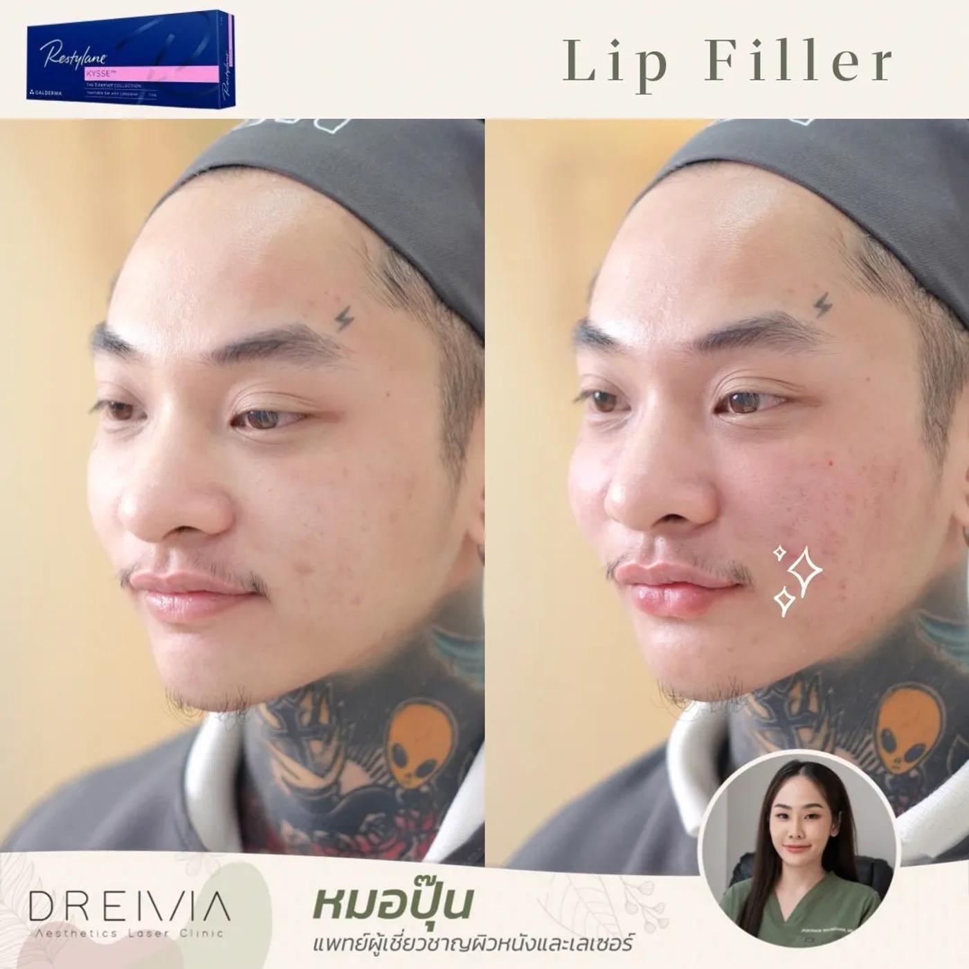 รีวิว Filler ปาก 20
