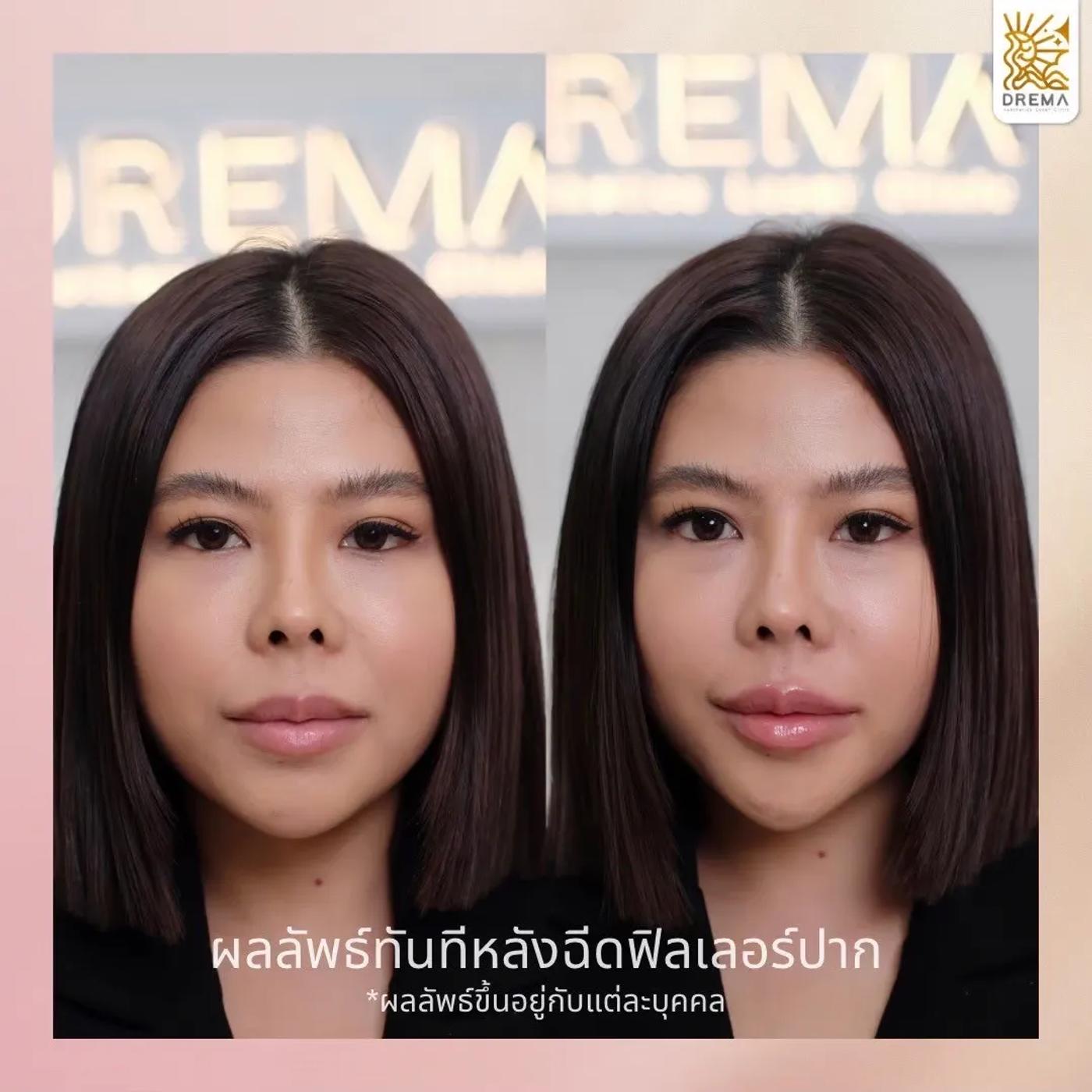 รีวิว Filler ปาก 7