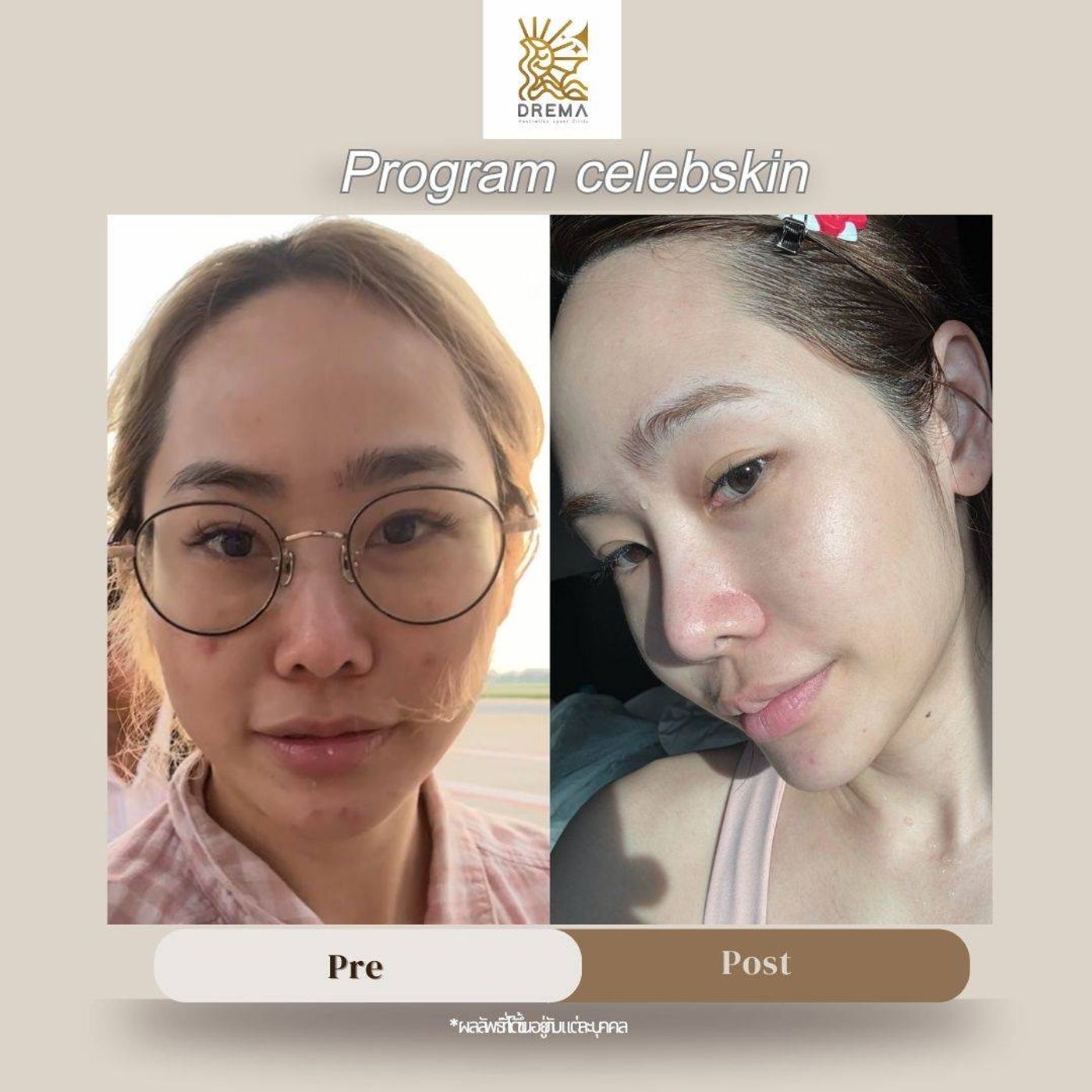 รูปรีวิว Skin Booster Drema Clinic เคสที่ 2
