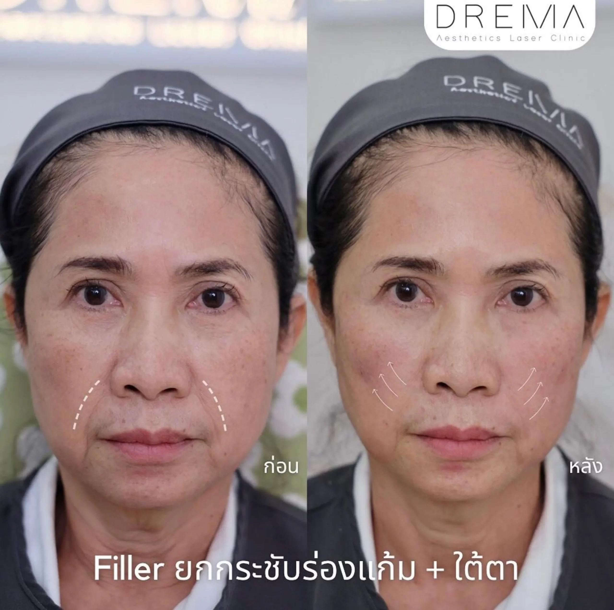 รีวิว Filler แก้มตอบ 1