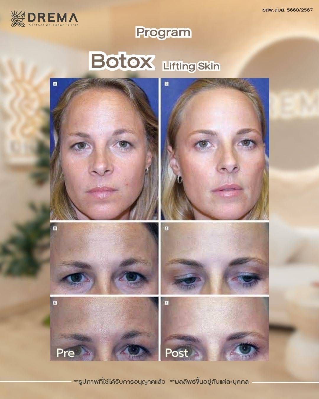 รูปรีวิว Botox Drema Clinic เคสที่ 2