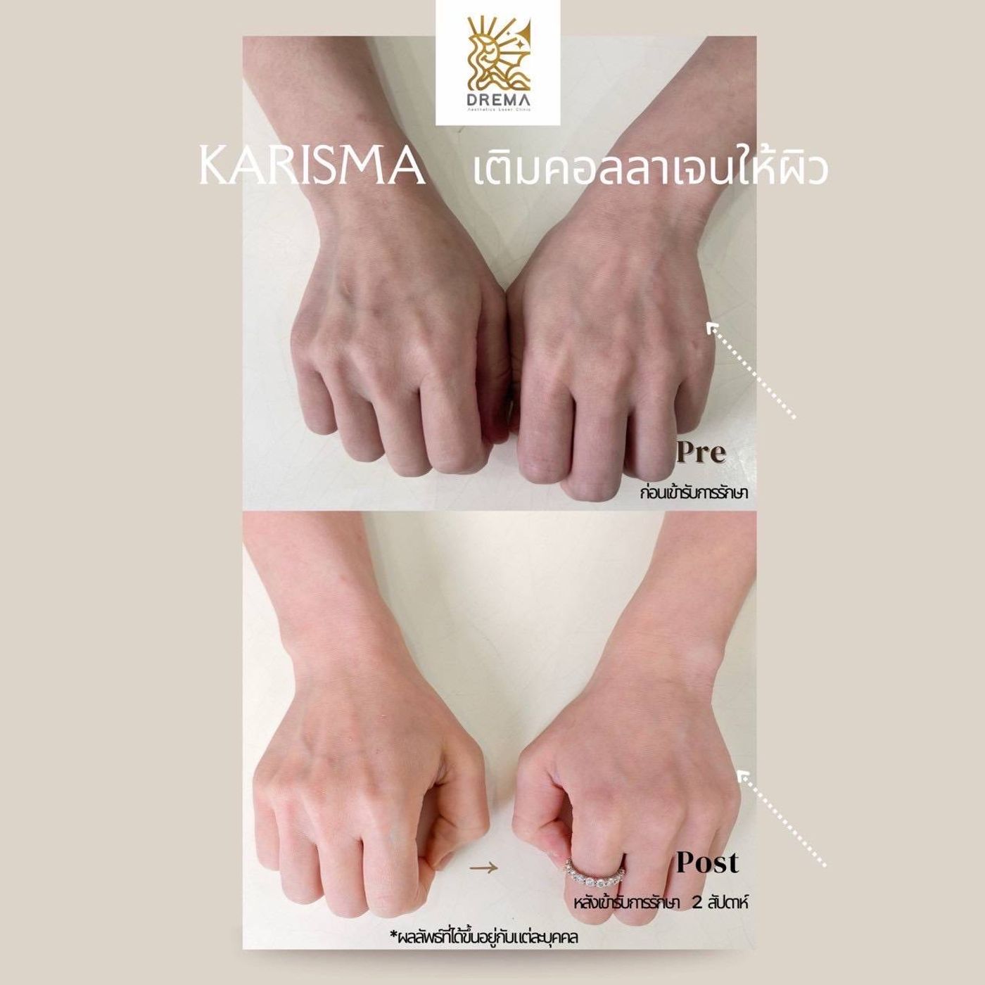 รูปรีวิว Skin Booster Drema Clinic เคสที่ 13