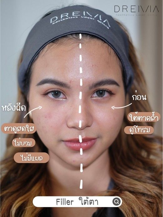 รีวิวฟิลเลอร์ใต้ตา 20