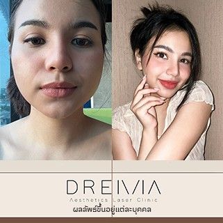 รีวิว Filler ปาก 44
