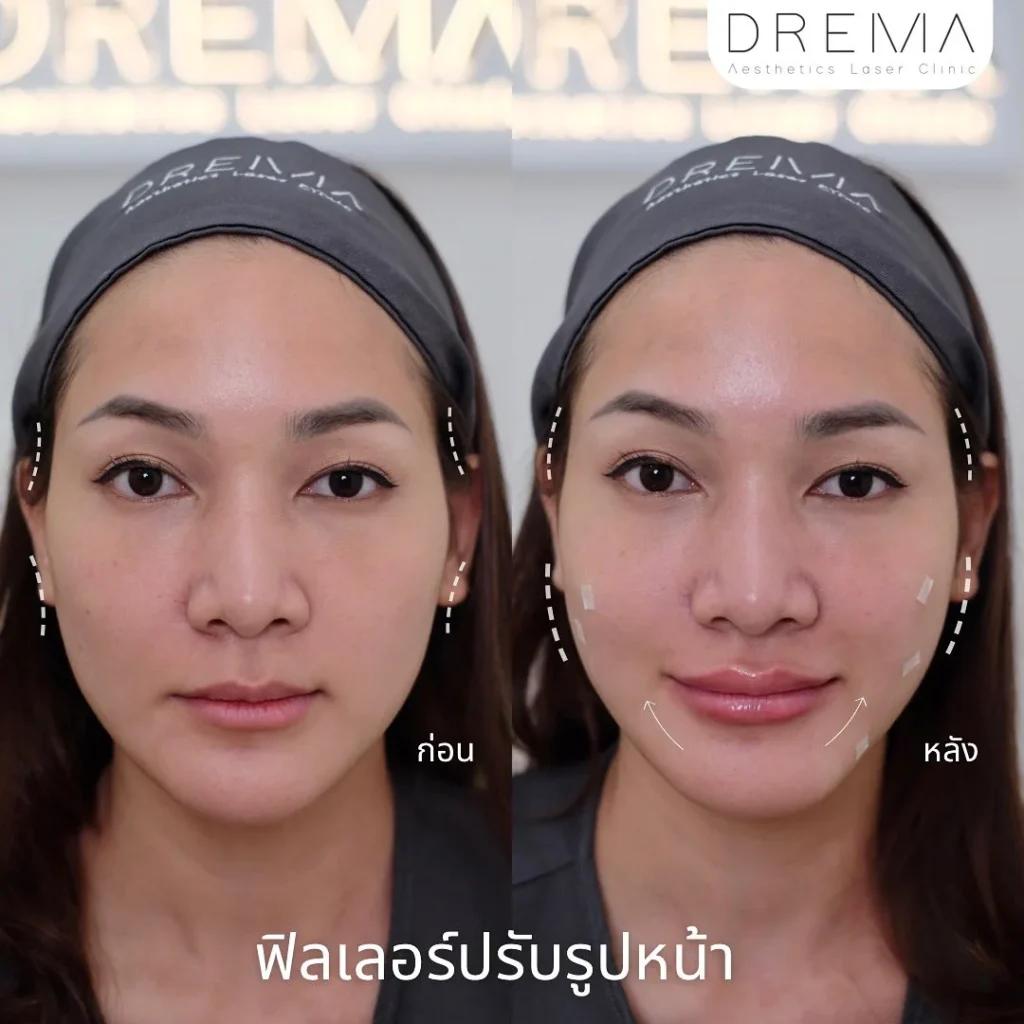 ฟิตเลอร์รับรูปหน้า