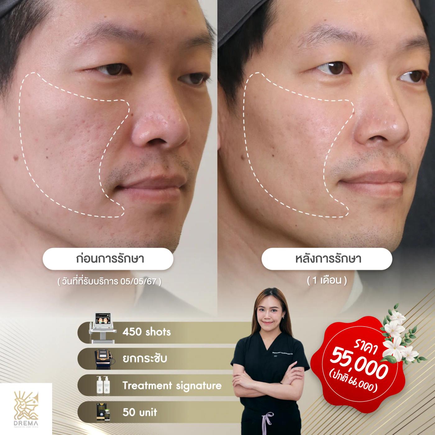รีวิว SYLFIRM X 11