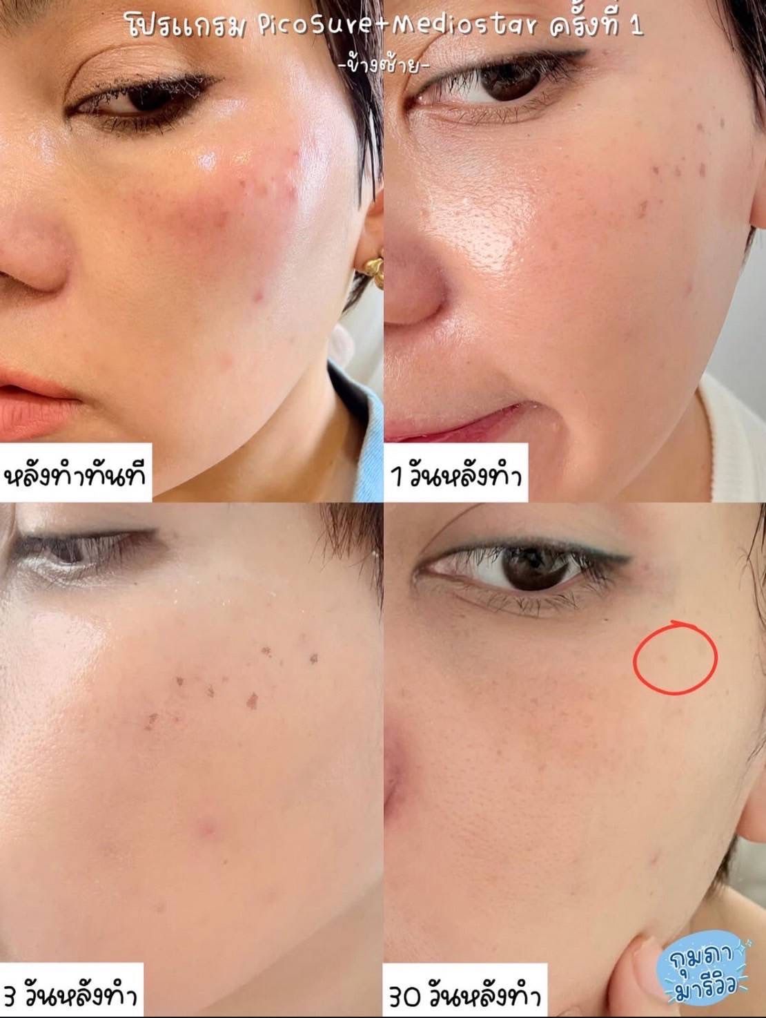 รูปรีวิว Pico Drema Clinic เคสที่ 16