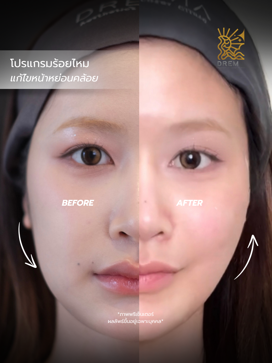 ก่อนและหลังร้อยไหม