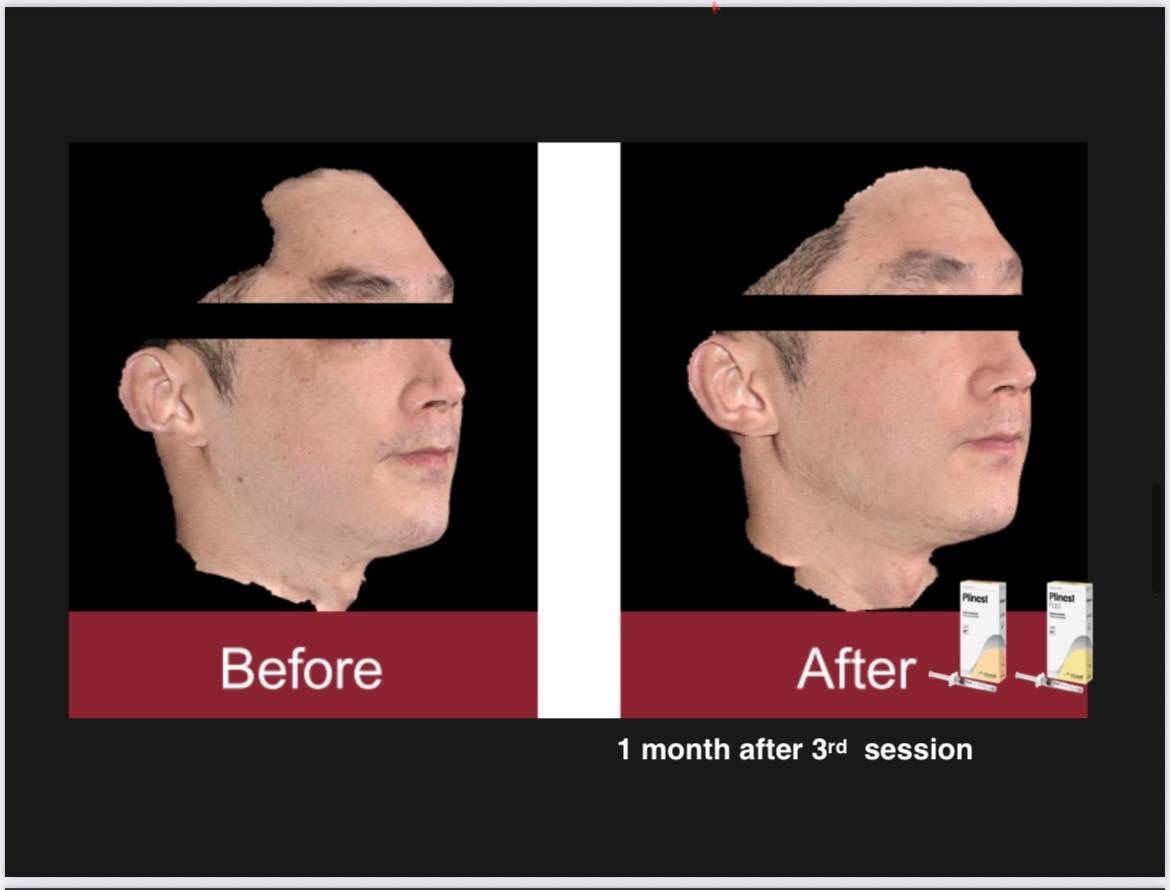 รูปรีวิว Skin Booster Drema Clinic เคสที่ 19