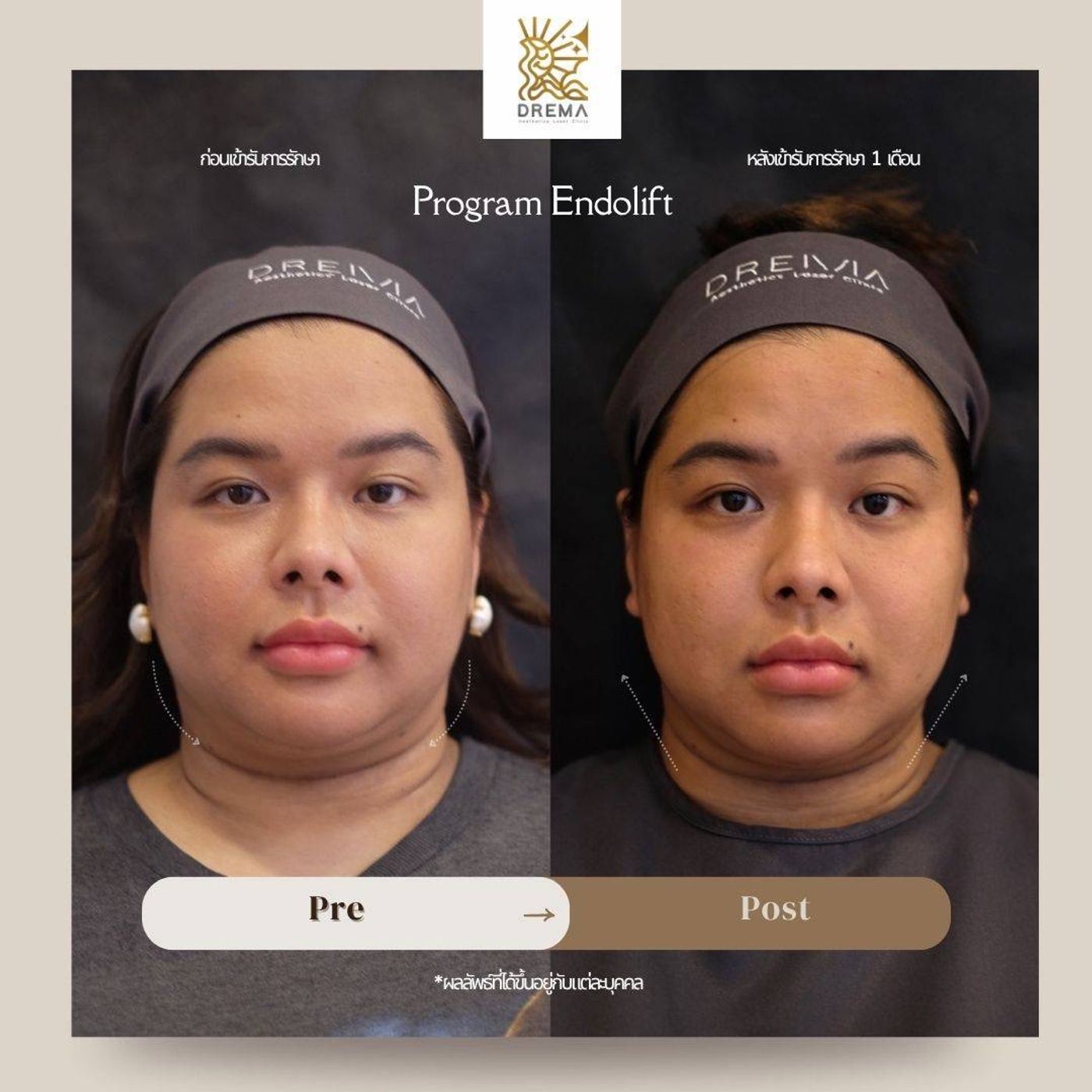 รูปรีวิว Endolift Drema Clinic เคสที่ 2