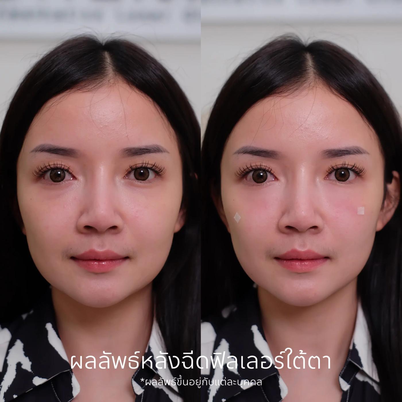 รีวิวฟิลเลอร์ใต้ตา 10