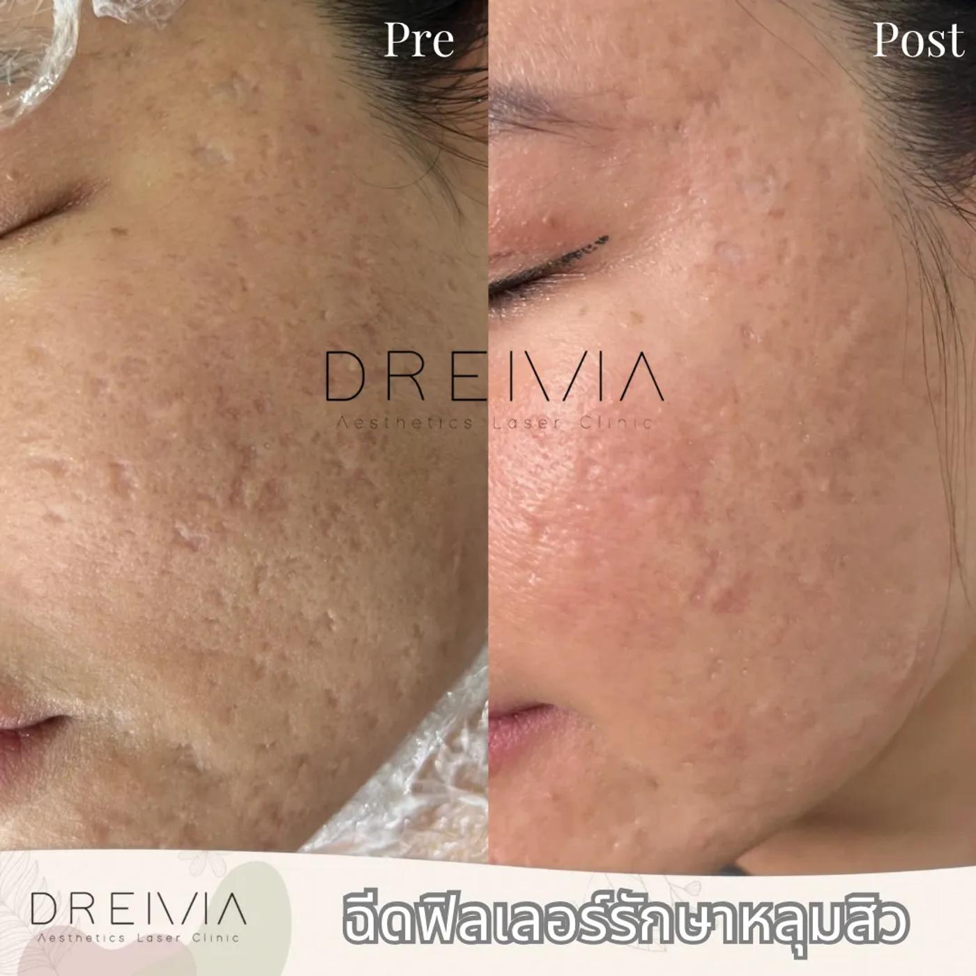 รีวิว SYLFIRM X 12