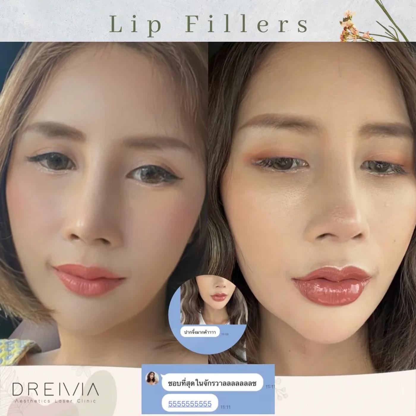 รีวิว Filler ปาก 26