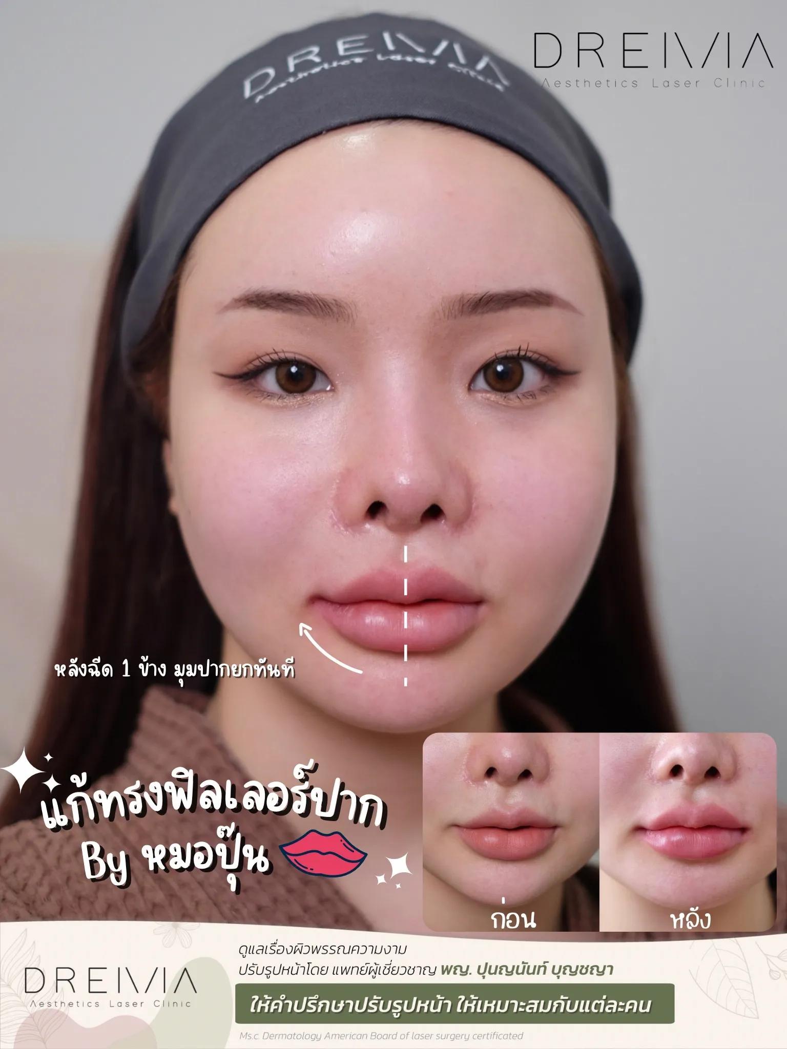 รีวิว Filler ปาก 13