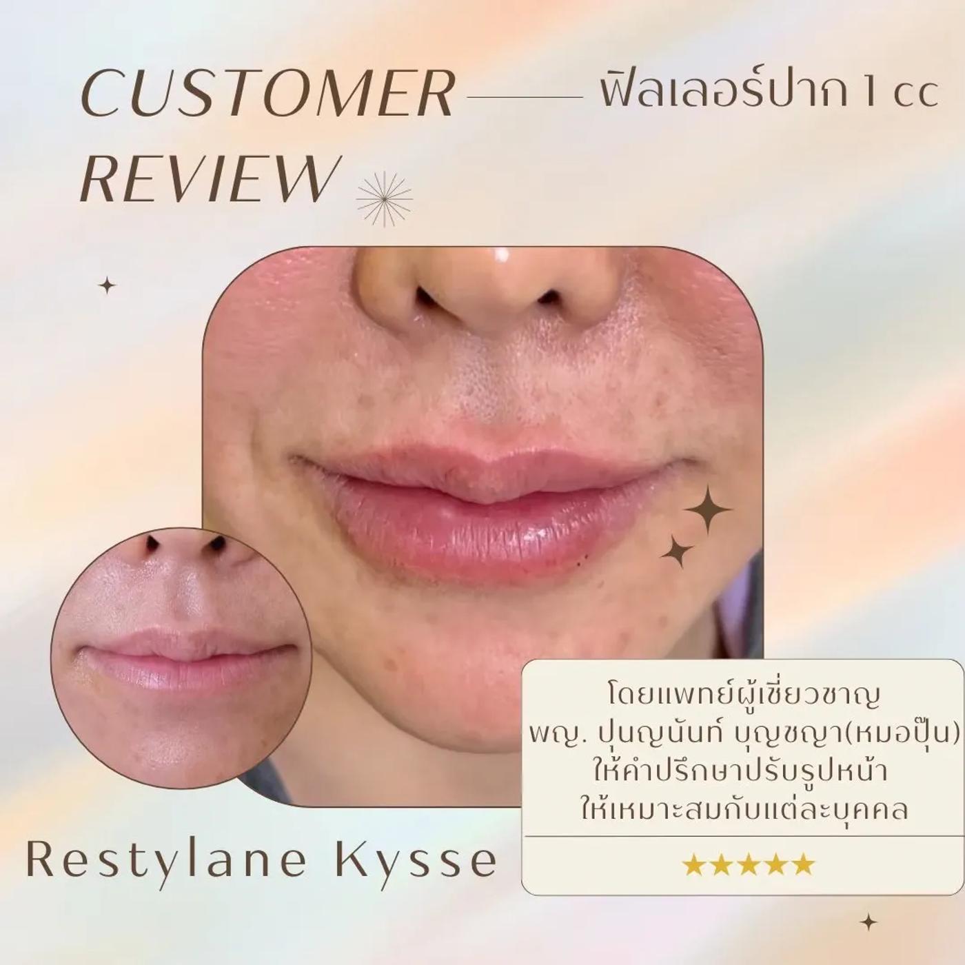 รีวิว Filler ปาก 41