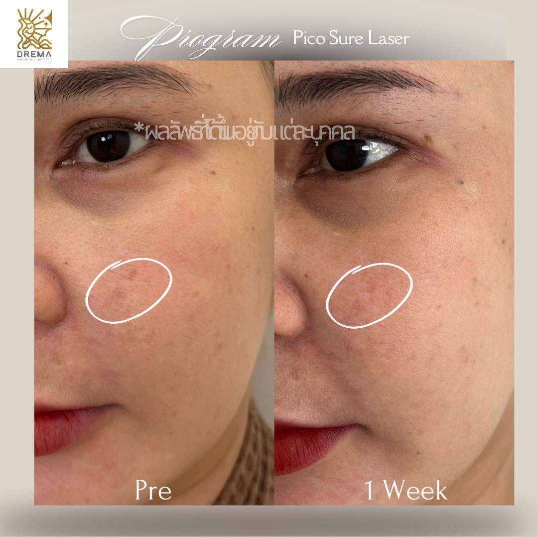 รีวิว Pico Drema Clinic