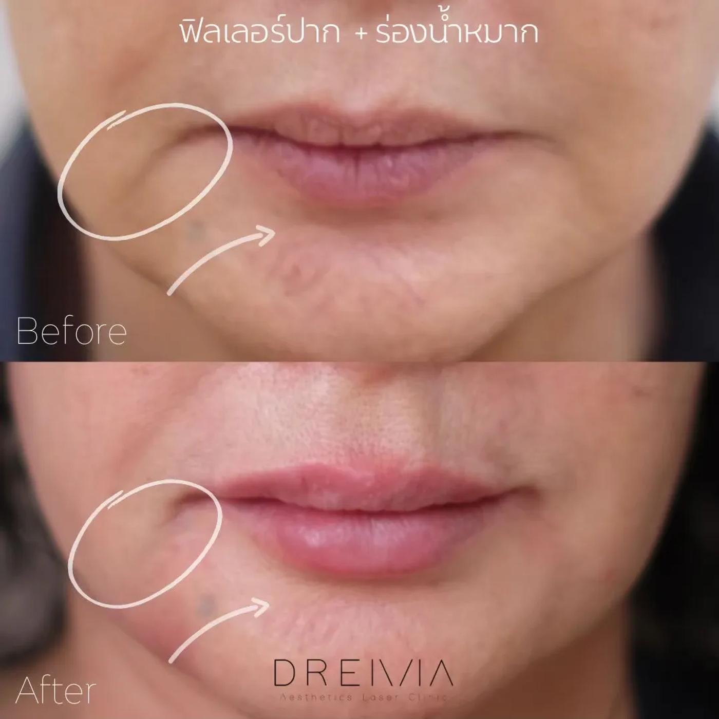 รีวิว Filler ปาก 38