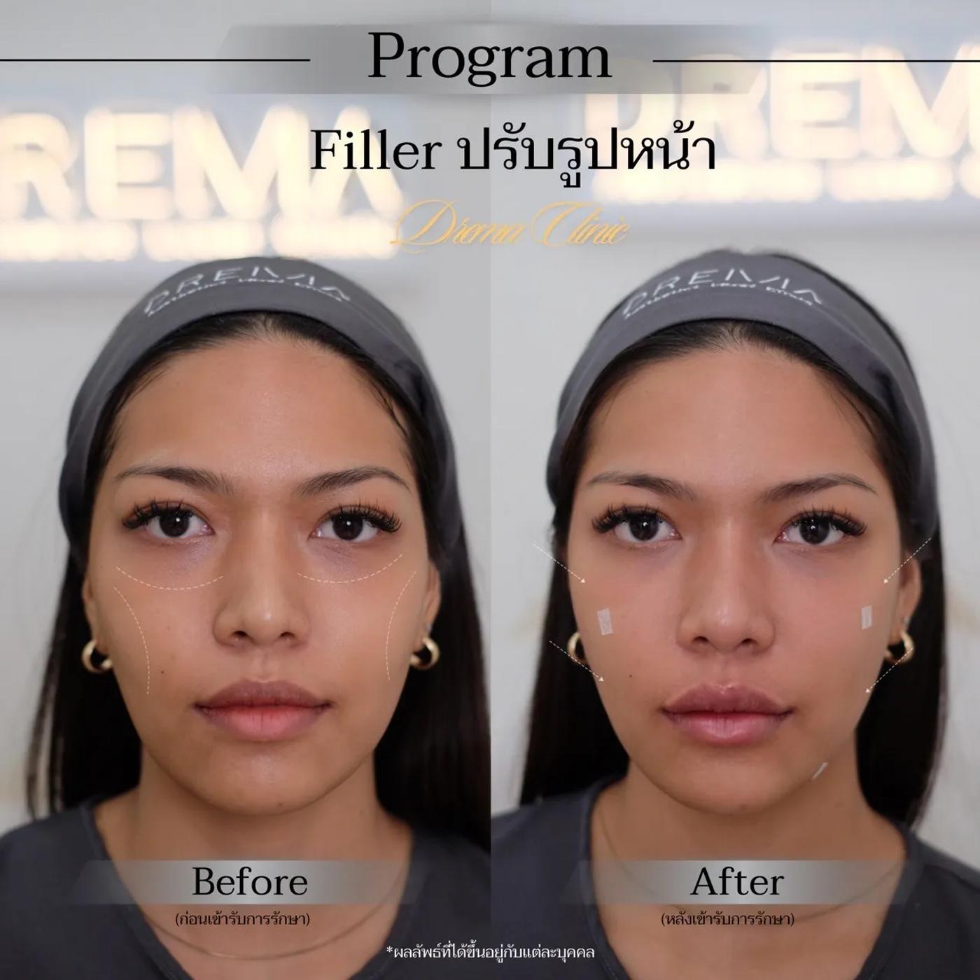 รีวิวการปรับรูปหน้า 18