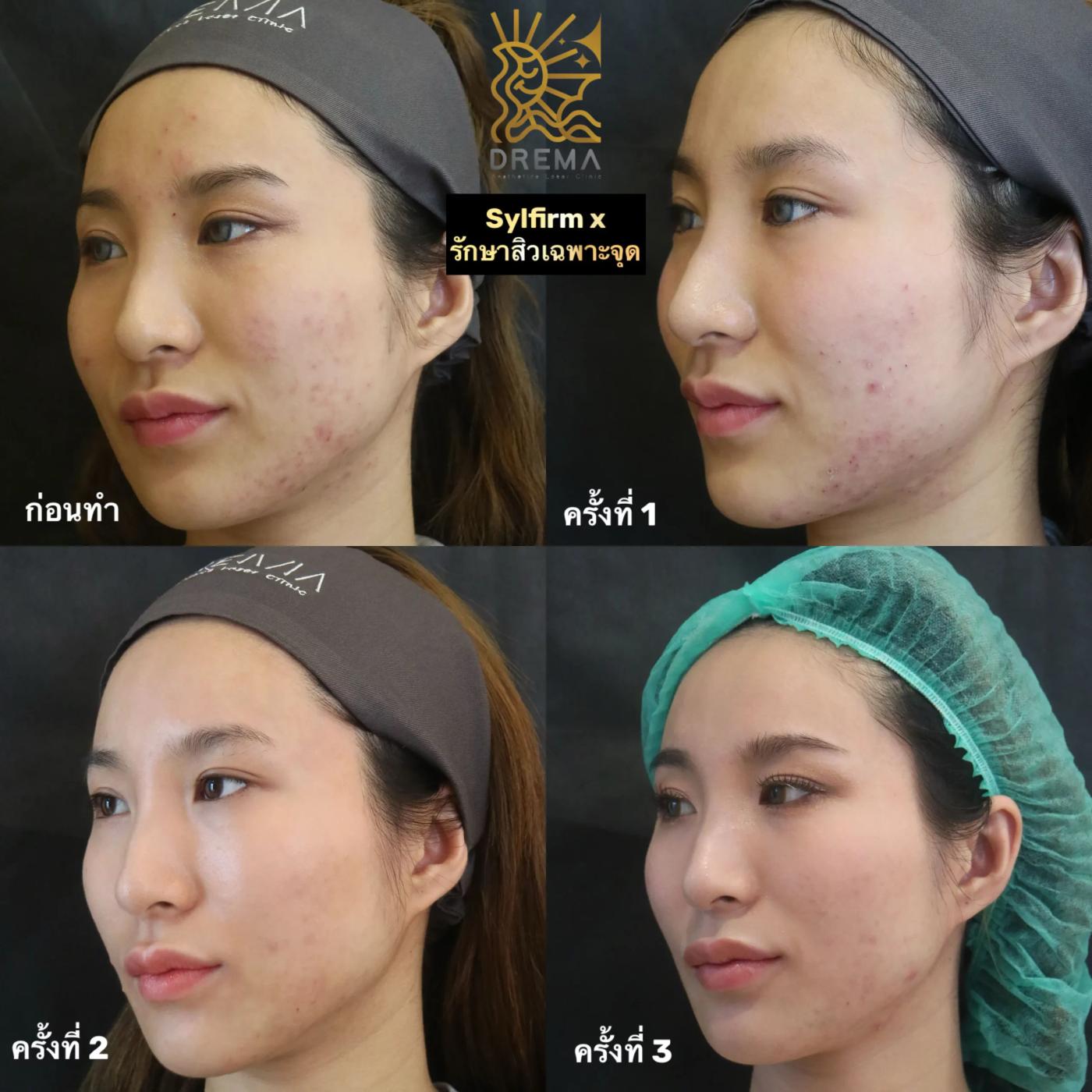 รีวิว SYLFIRM X 29