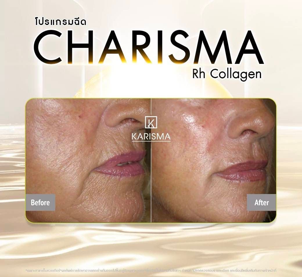 รูปรีวิว Skin Booster Drema Clinic เคสที่ 11