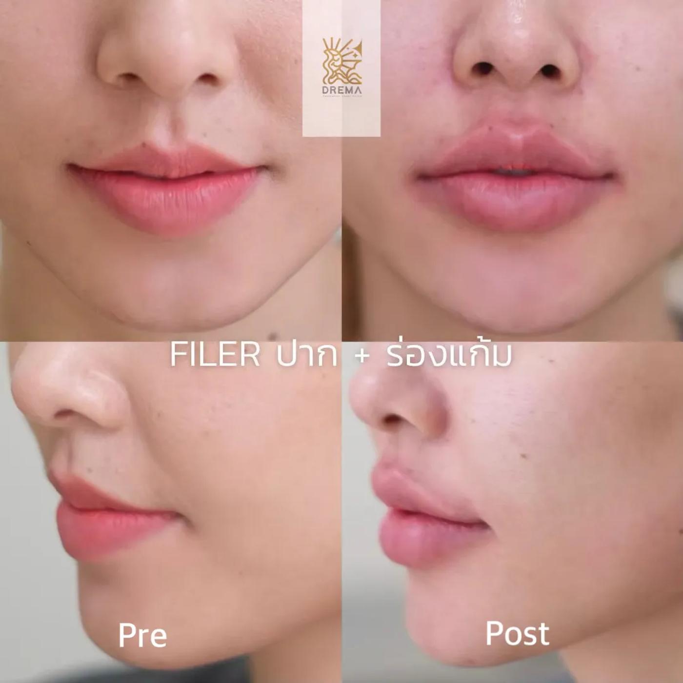 รีวิว Filler ปาก 30