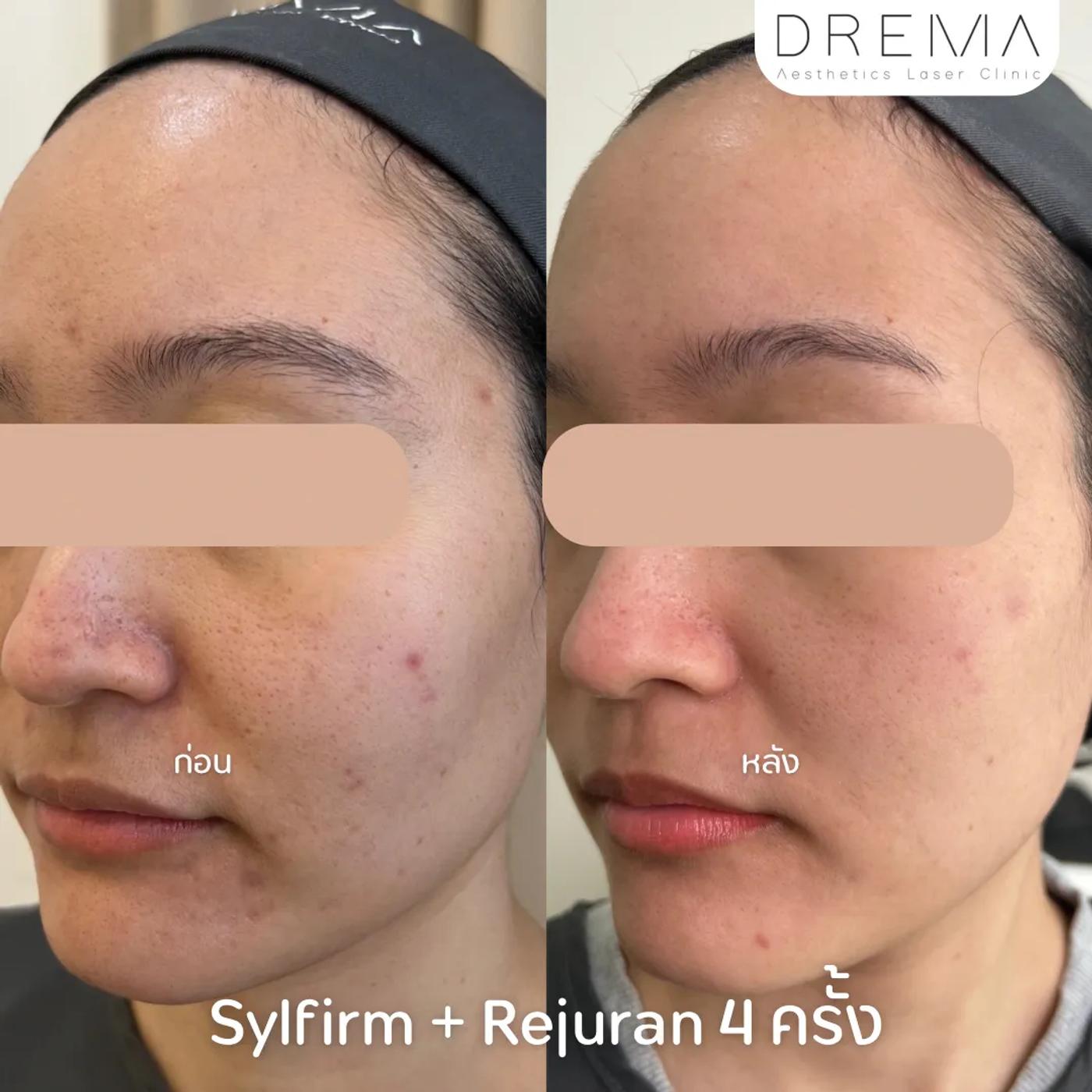 รีวิว SYLFIRM X 7
