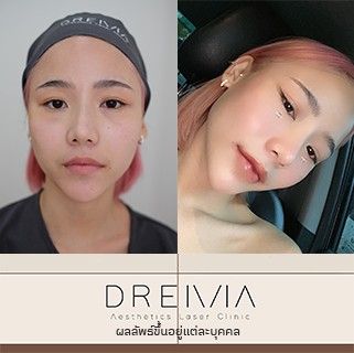รีวิว Filler ปาก 47