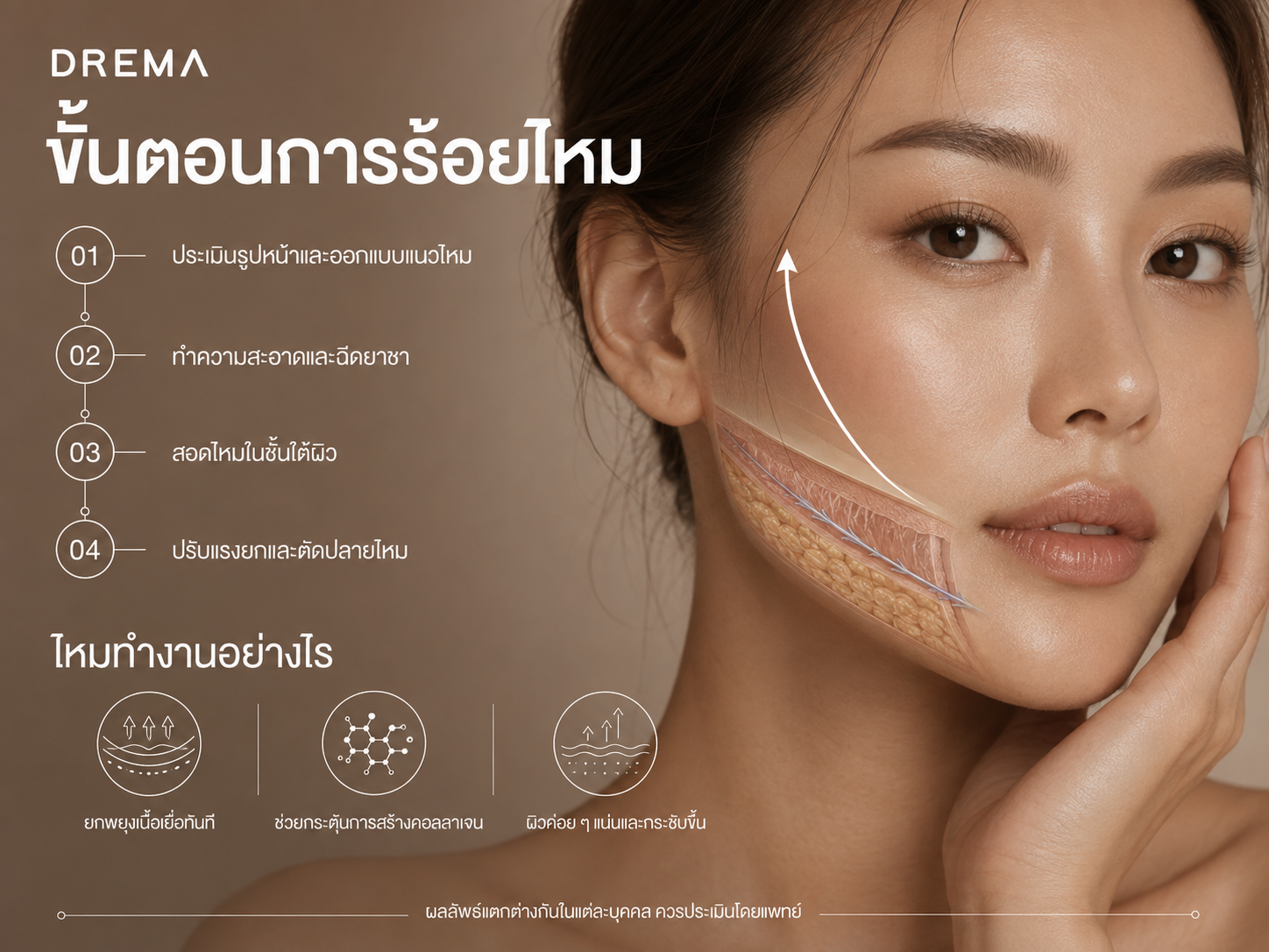 ขั้นตอนการร้อยไหม