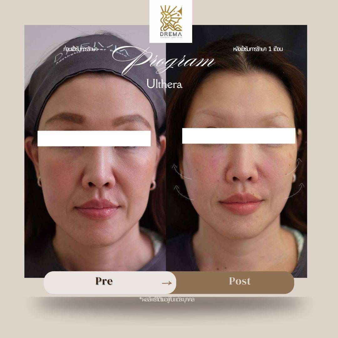 รูปรีวิว Ulthera Drema Clinic เคสที่ 1