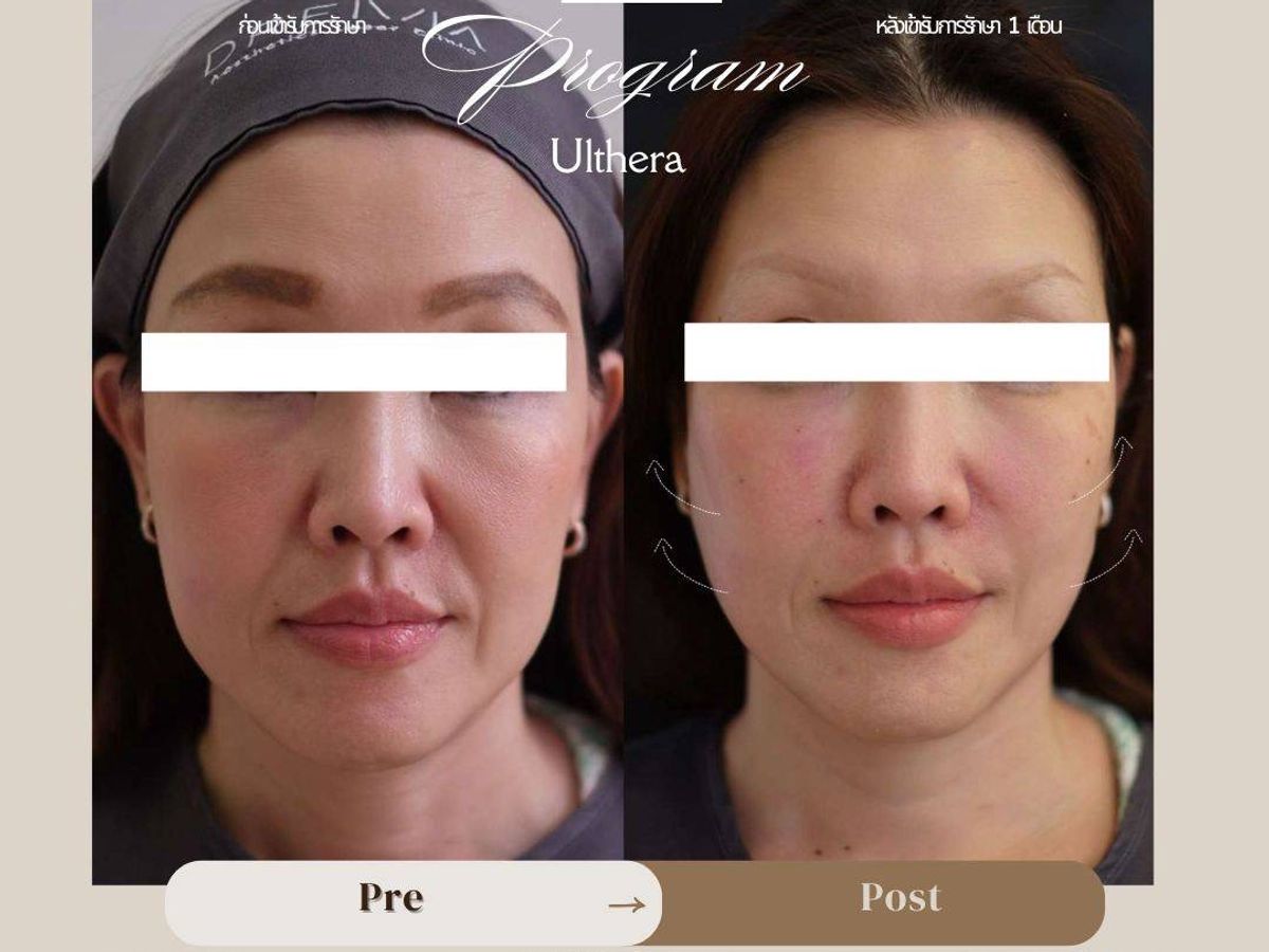 รูปรีวิว Ulthera Drema Clinic เคสที่ 1