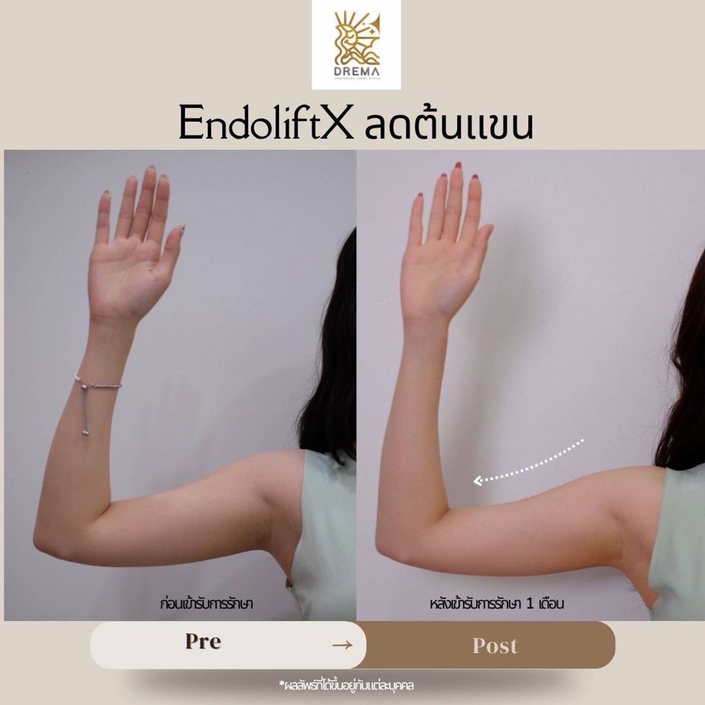 รูปรีวิว Endolift Drema Clinic เคสที่ 10