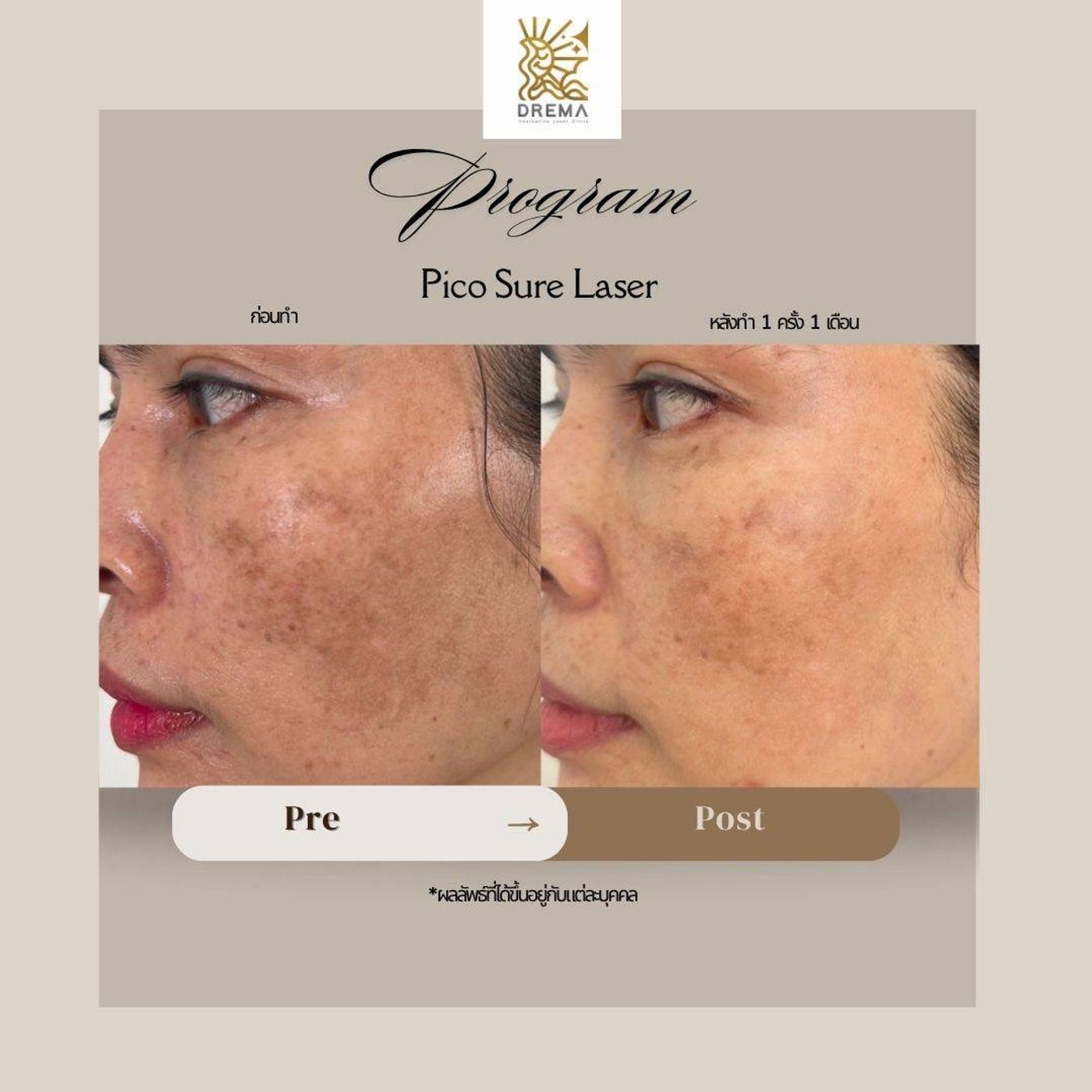 รูปรีวิว Pico Drema Clinic เคสที่ 20