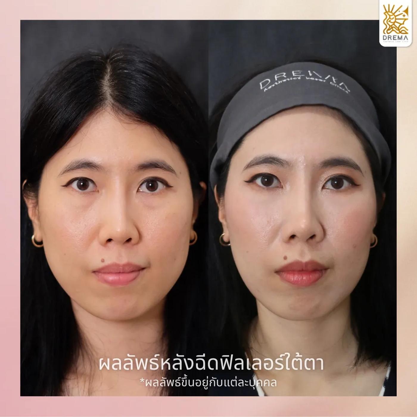 รีวิวฟิลเลอร์ใต้ตา 4