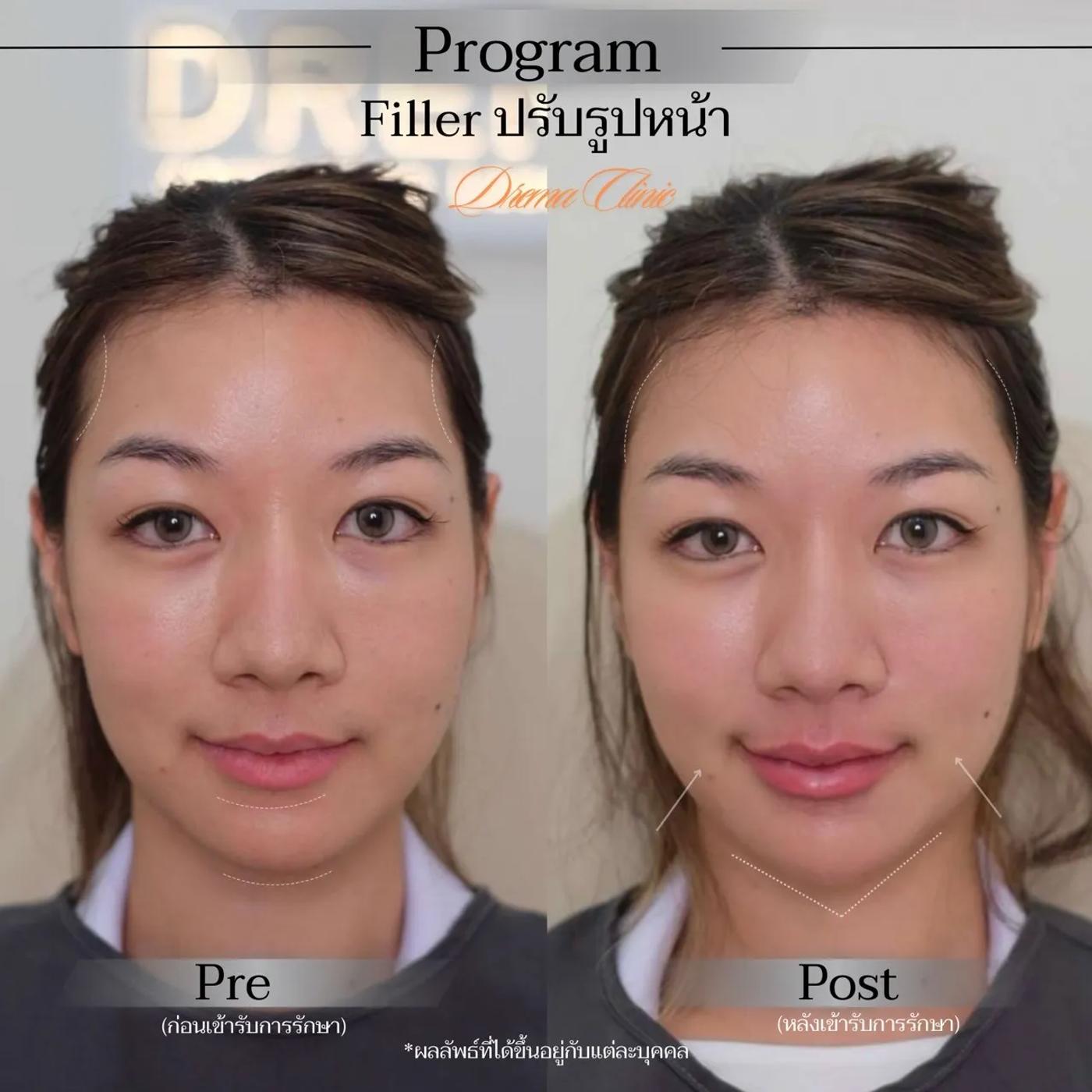 รีวิวการปรับรูปหน้า 16