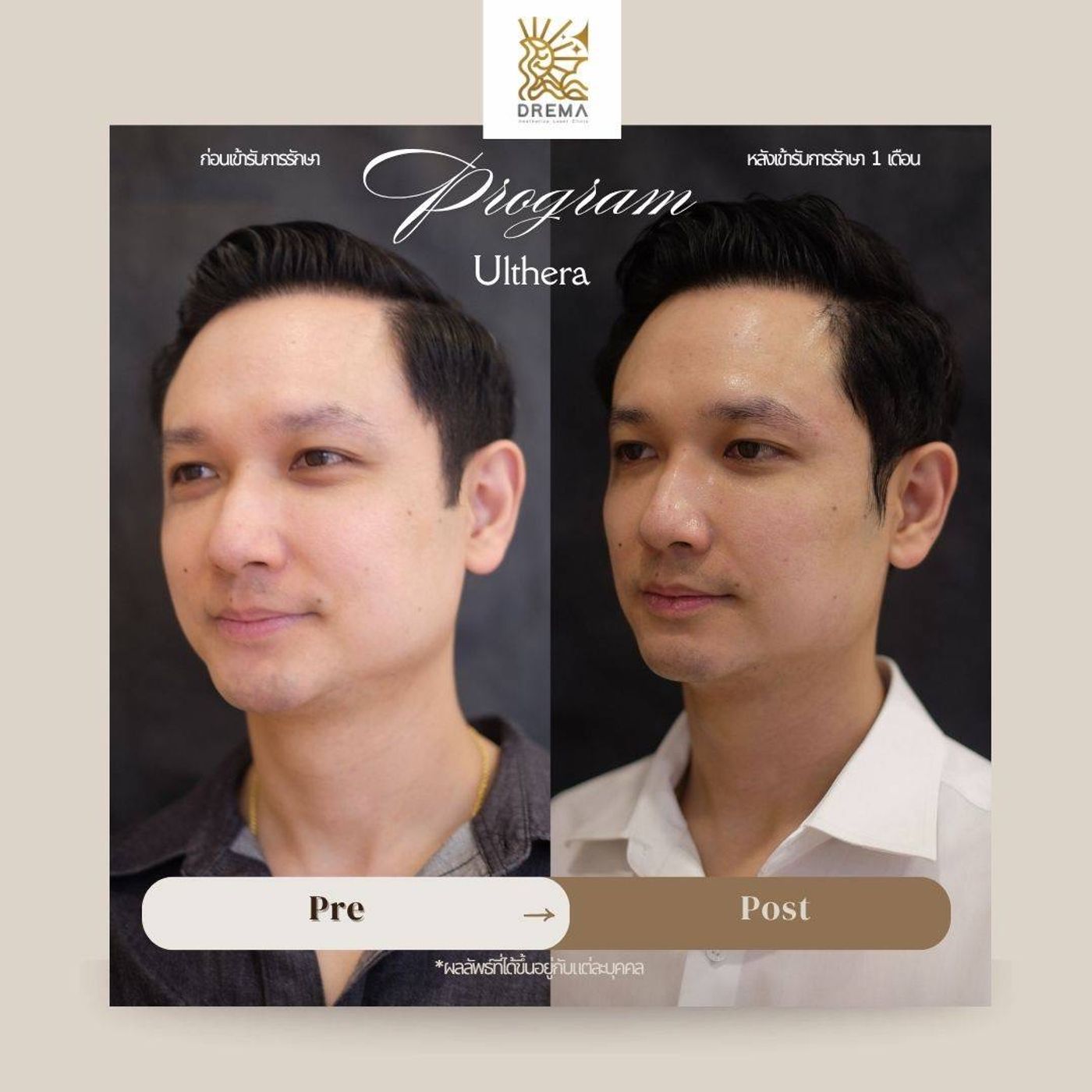 รูปรีวิว Ulthera Drema Clinic เคสที่ 8