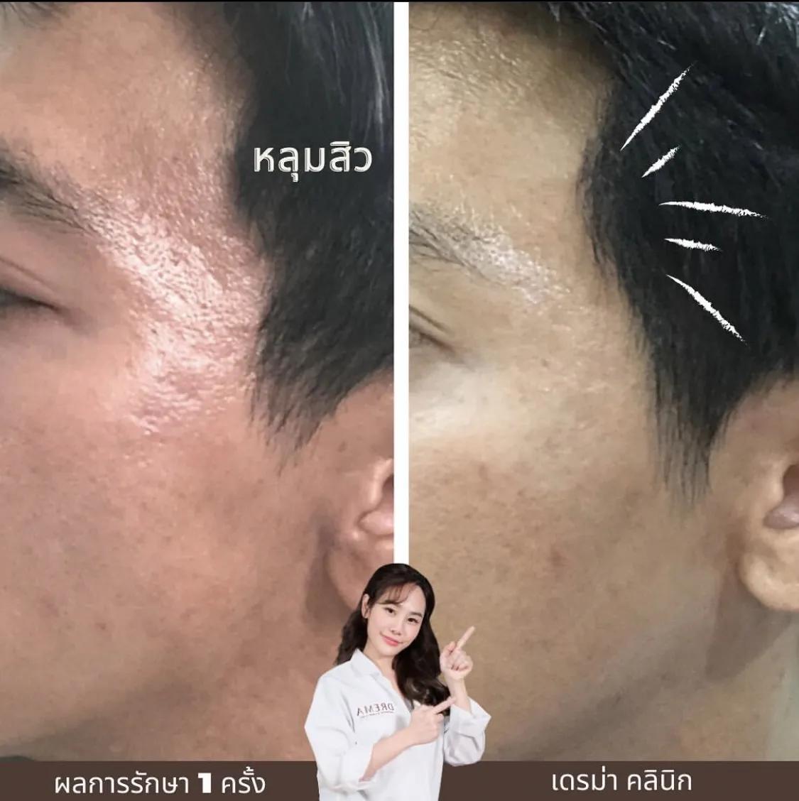 รีวิว SYLFIRM X 17