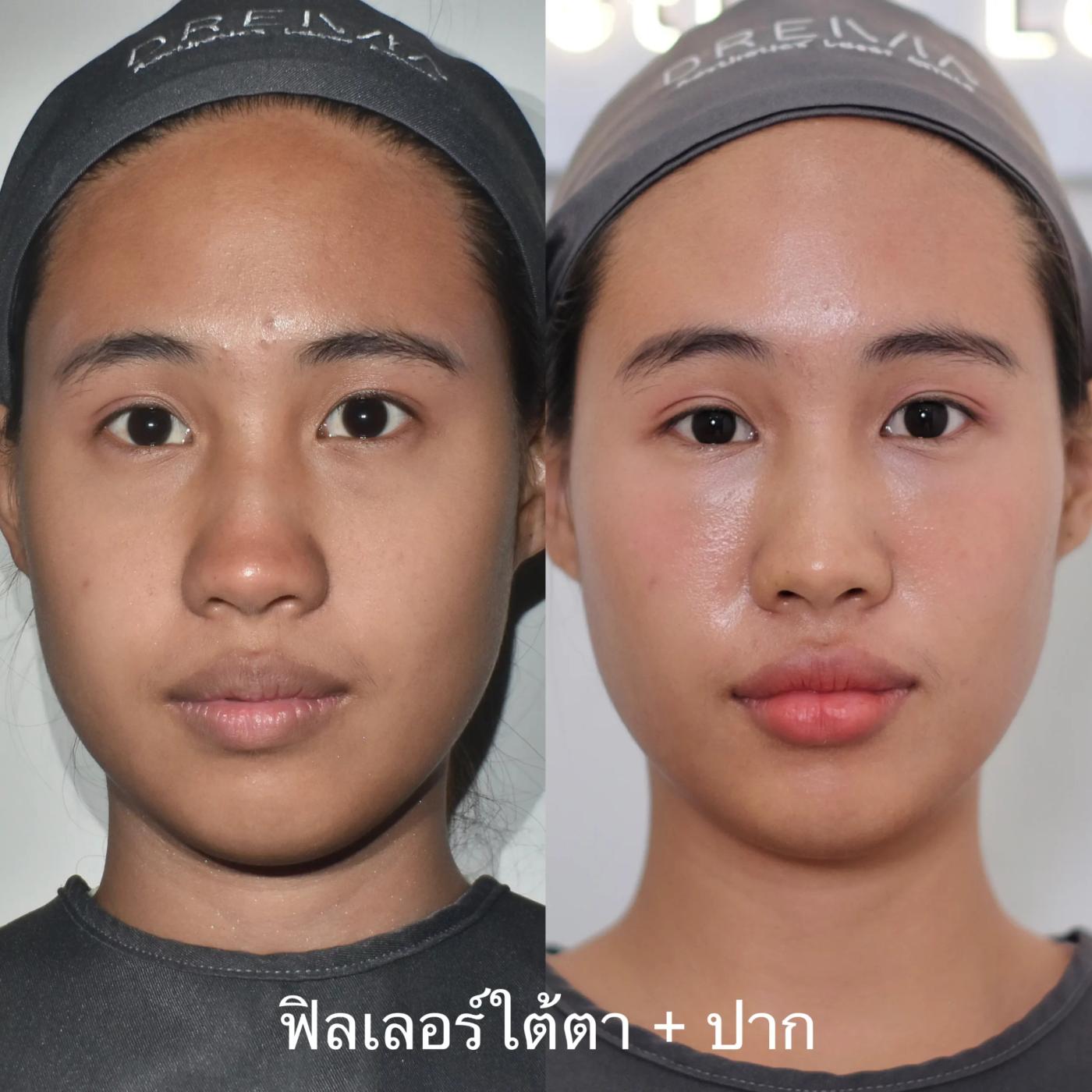 รีวิวฟิลเลอร์ใต้ตา 8