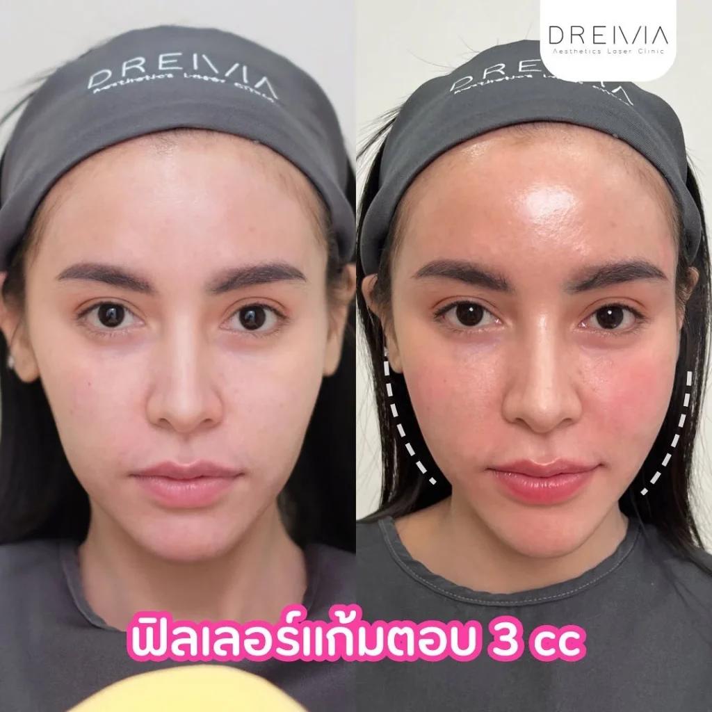ฟิตเลอร์แก้มตอบ 3cc
