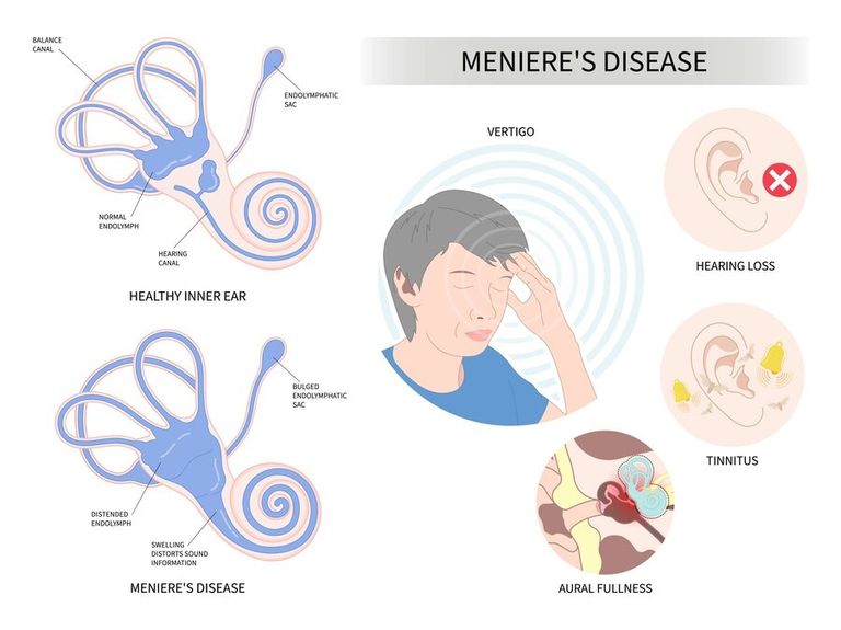 Menieres Disease Overview Treatment In Los Angeles 3583