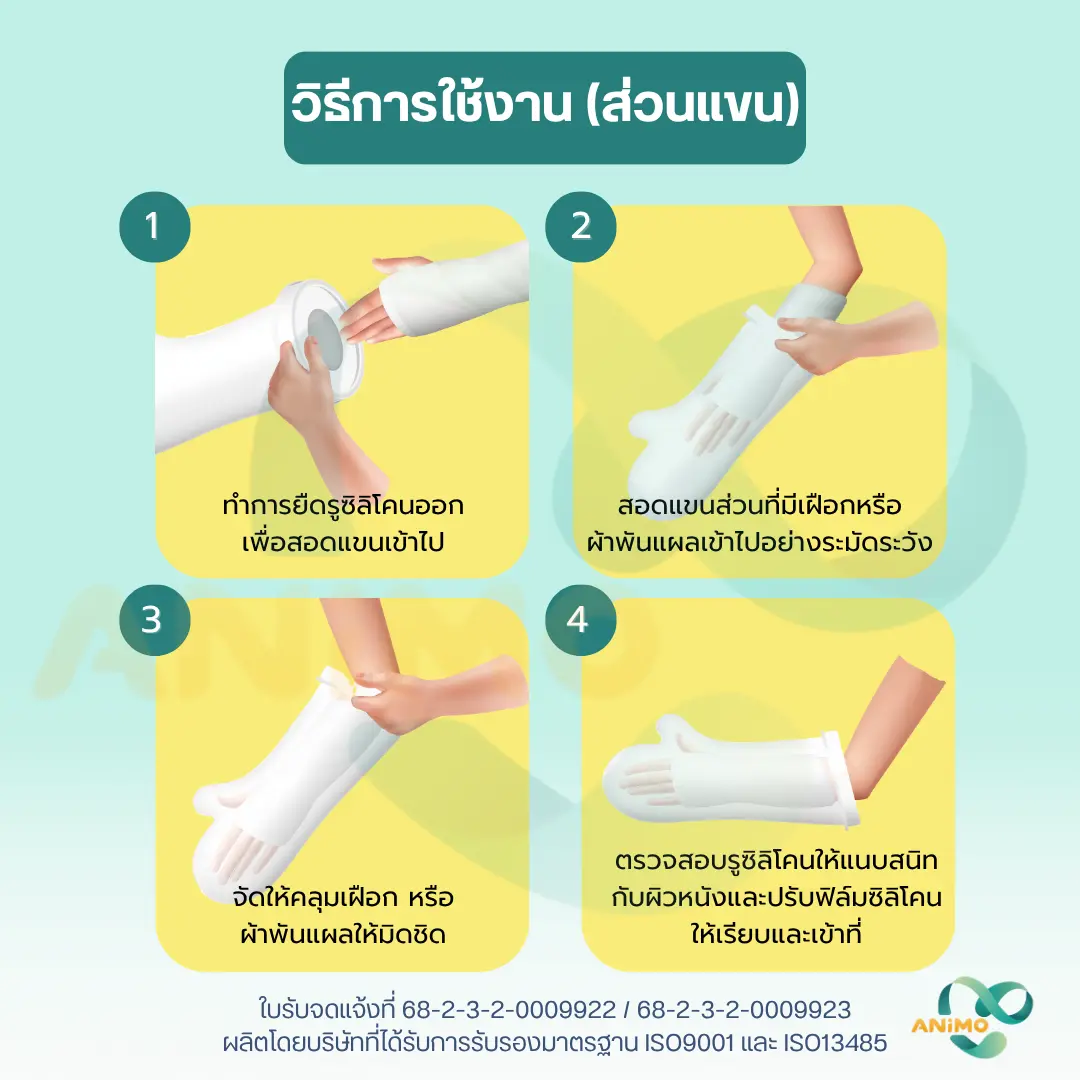 Waterproof Cast Protector for Shower – ปลอกกันน้ำสำหรับเฝือก ขณะอาบน้ำ
