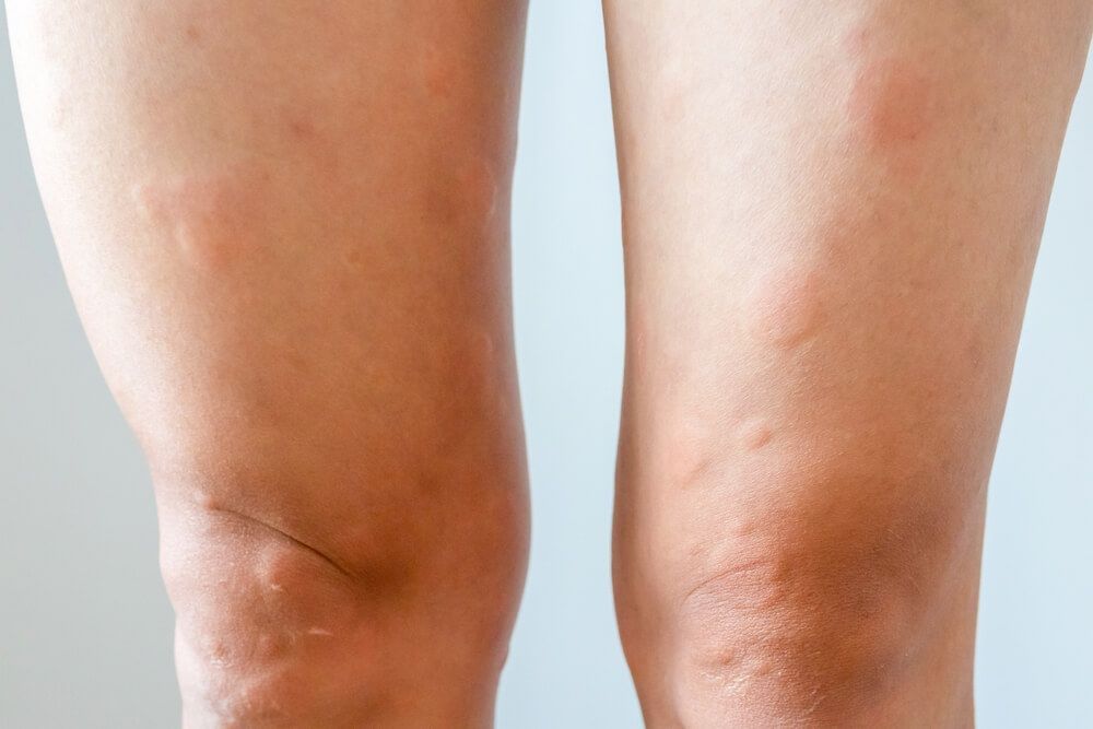 when is a compression stocking less suitable