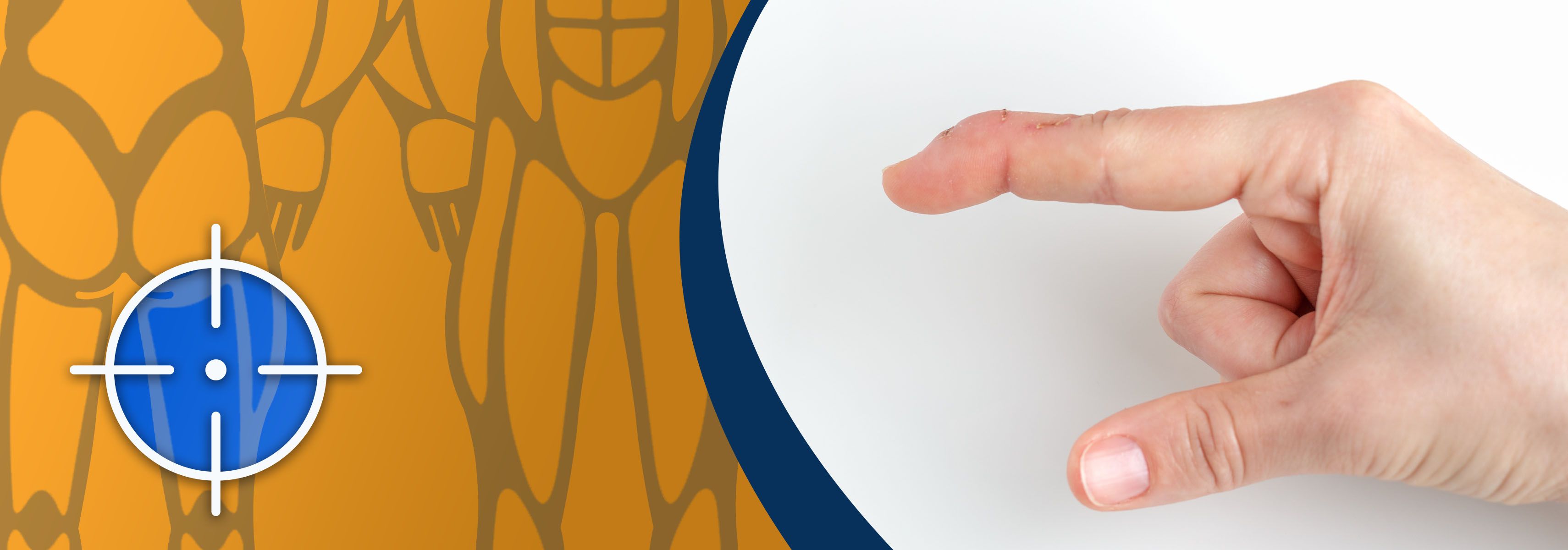 Mallet finger and working